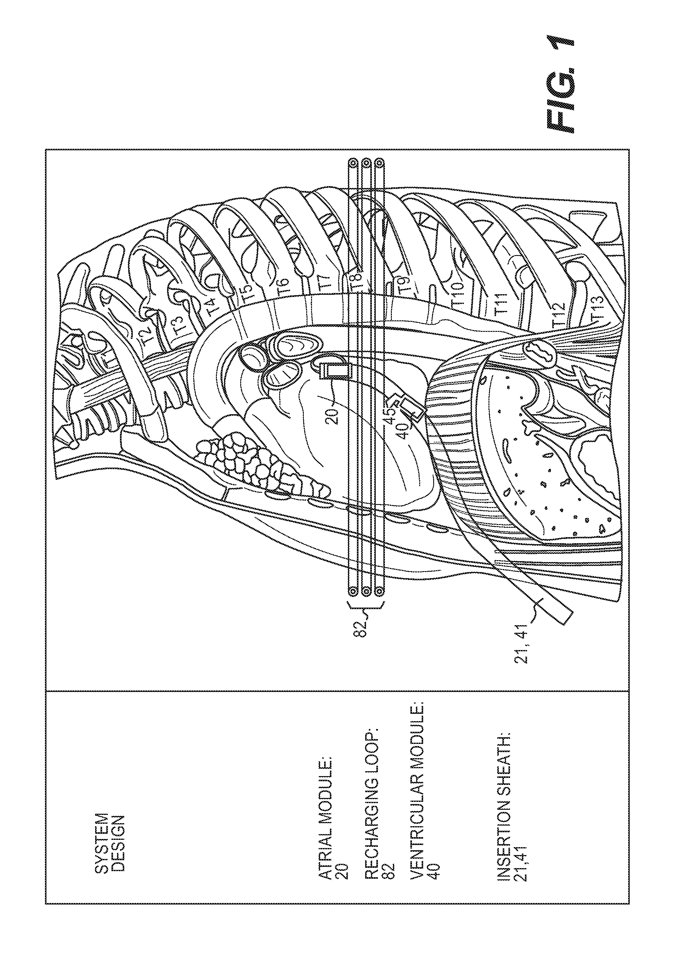 Epicardial lead design