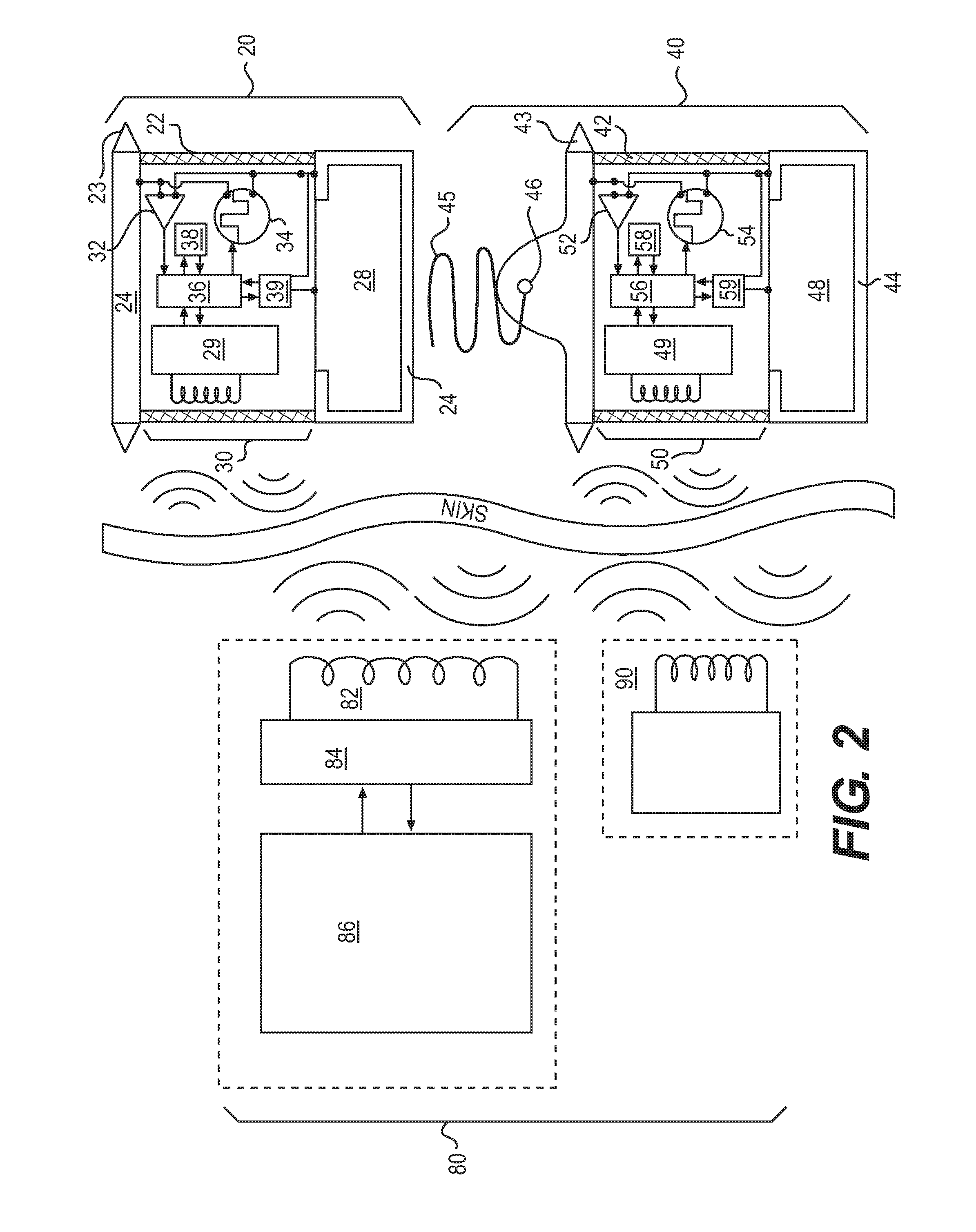 Epicardial lead design