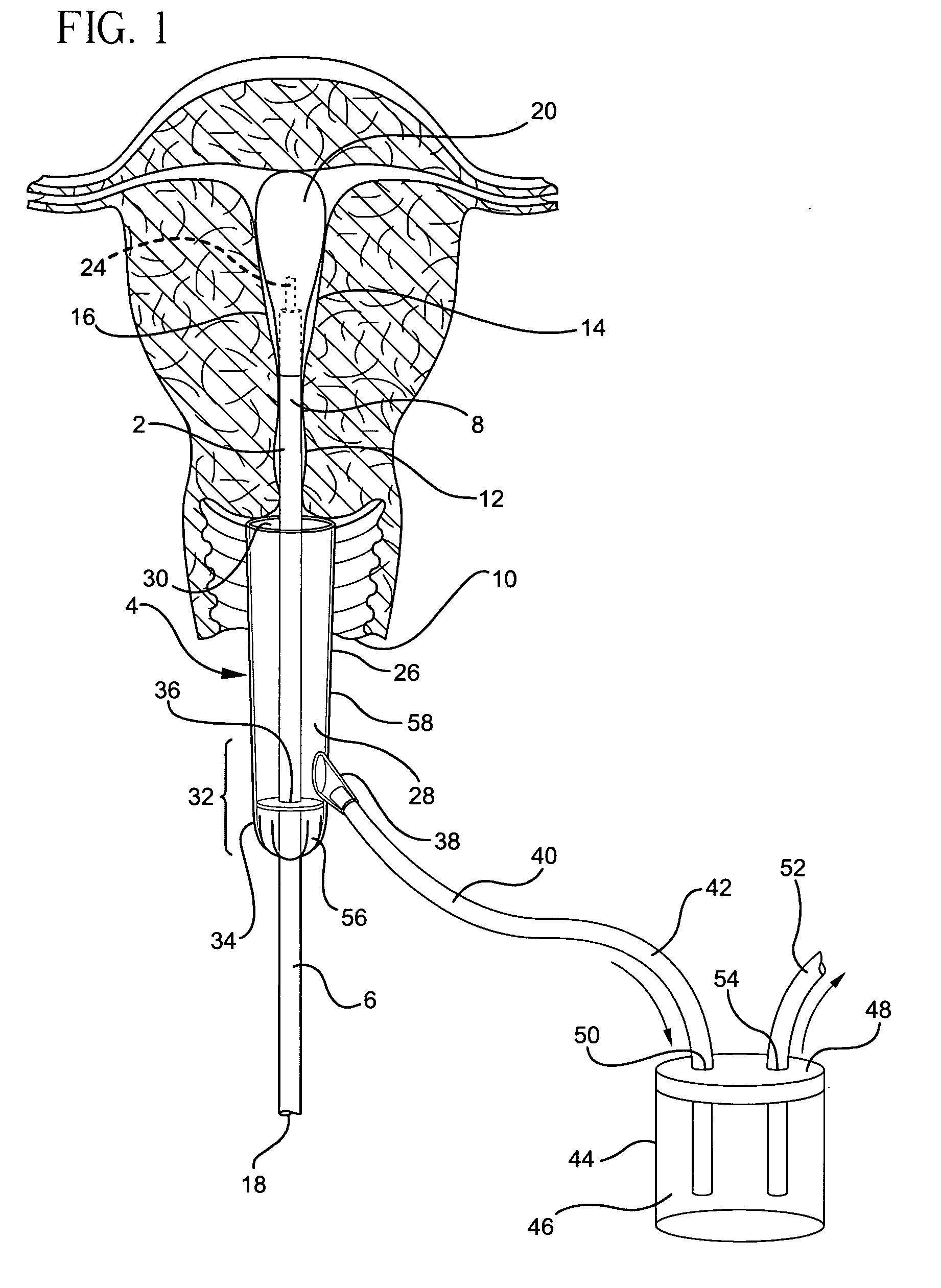 Method and apparatus for vaginal protection from hot fluids during endometrial ablation treatment