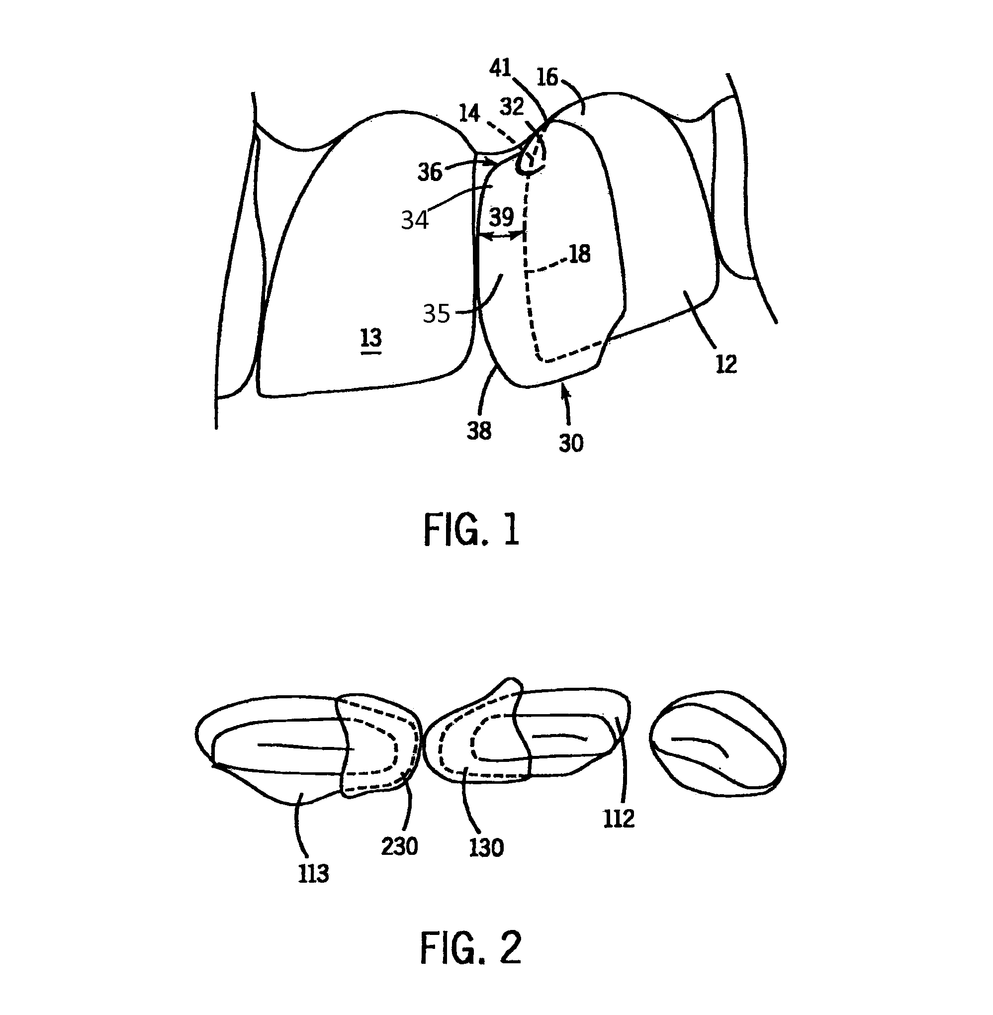 Methods and devices for diastema closure