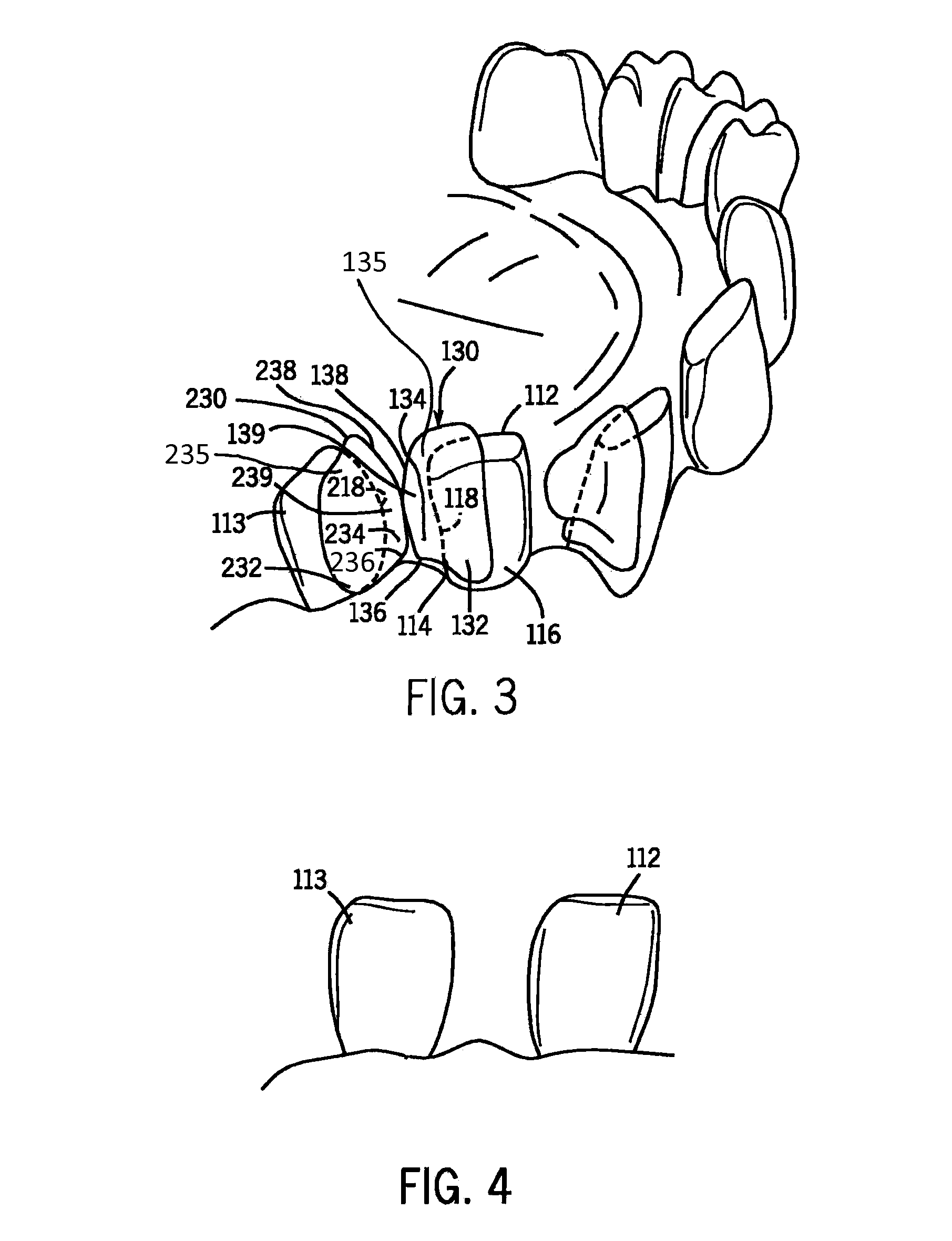 Methods and devices for diastema closure