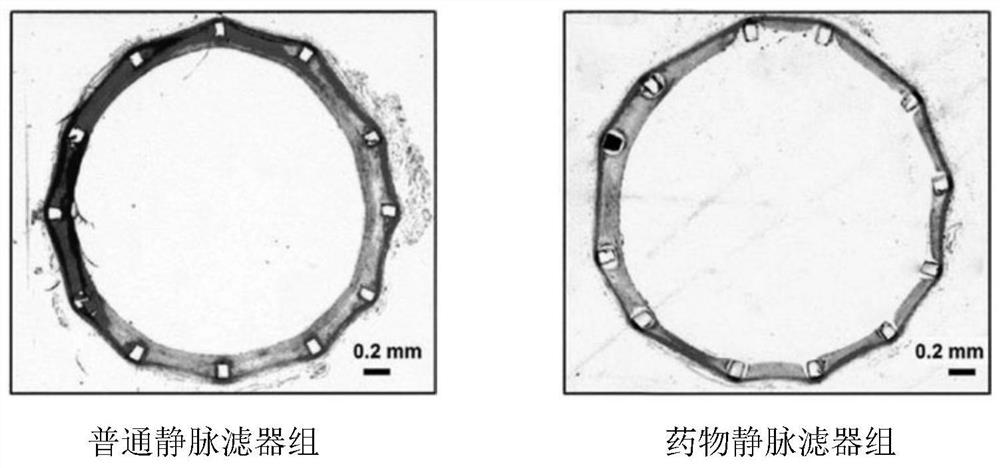 Medicine vein filter and manufacturing method thereof