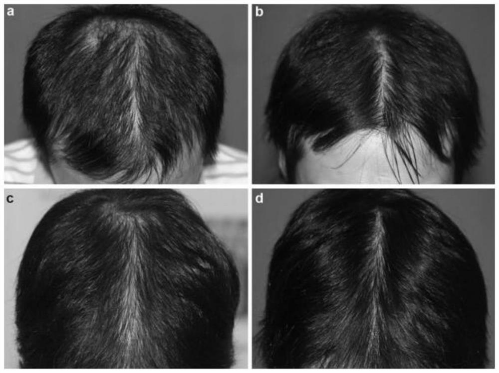 Novel exosome hydrolyzed sponge hair growth promoting liquid