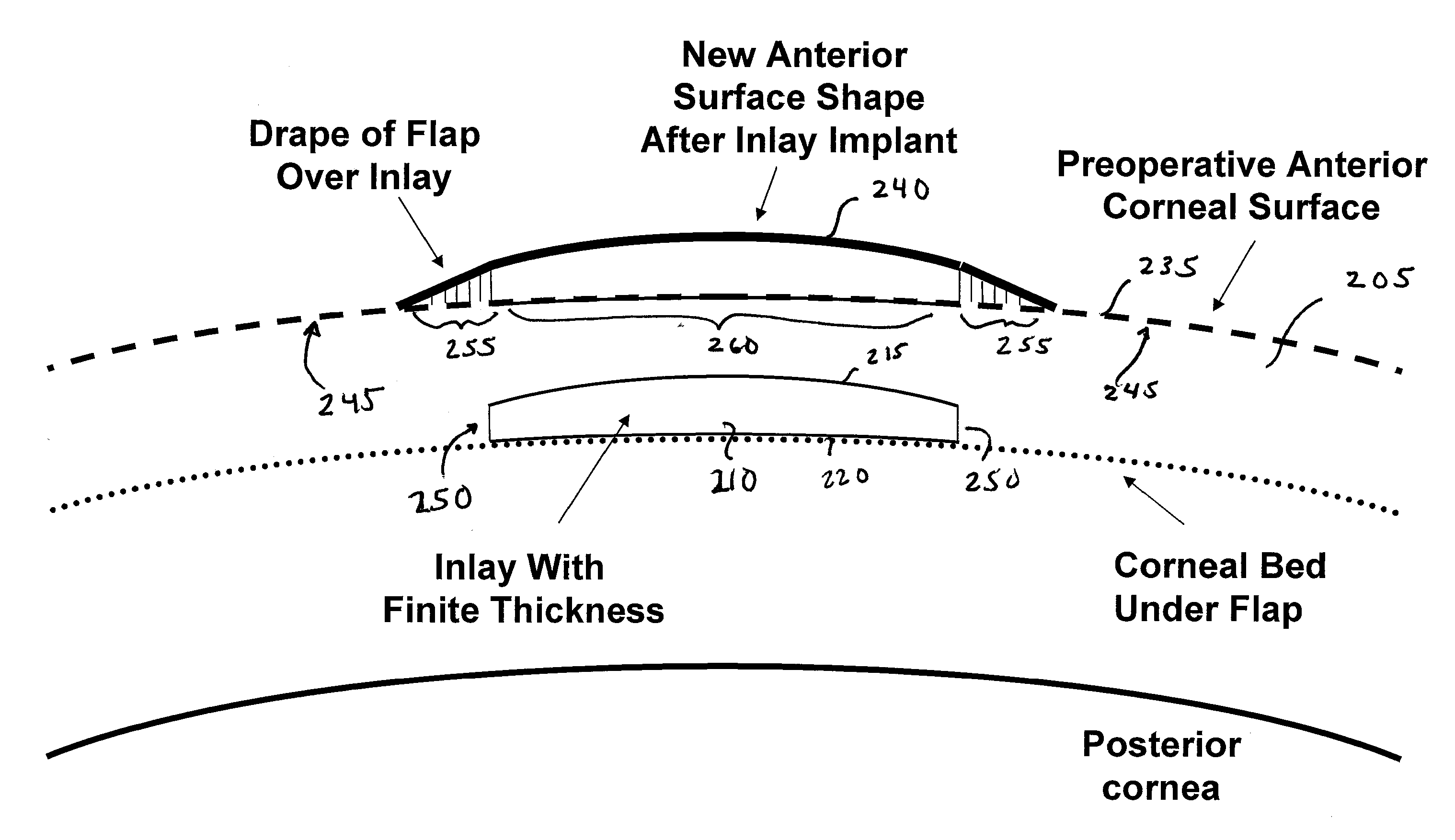 Small Diameter Inlays