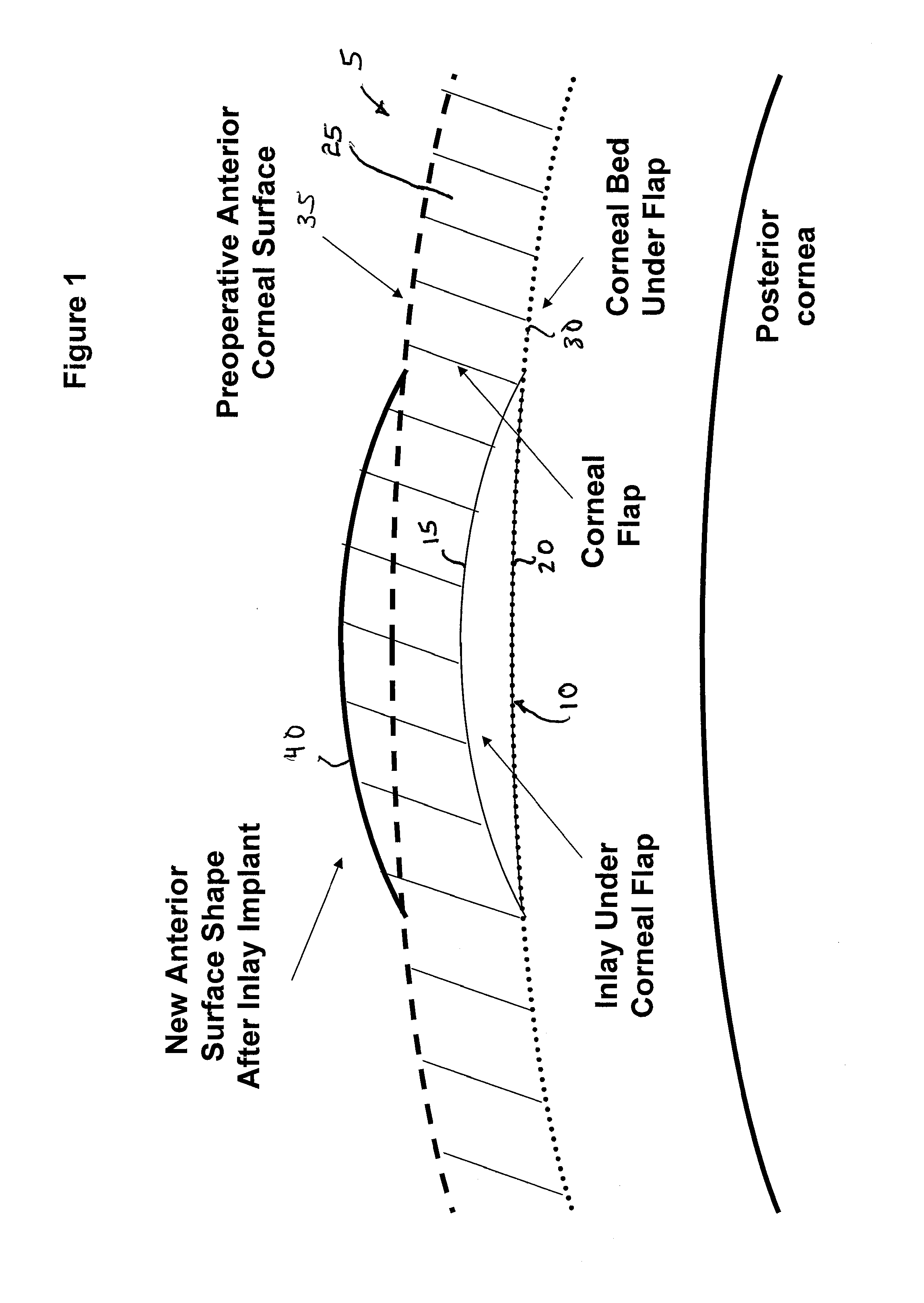 Small Diameter Inlays