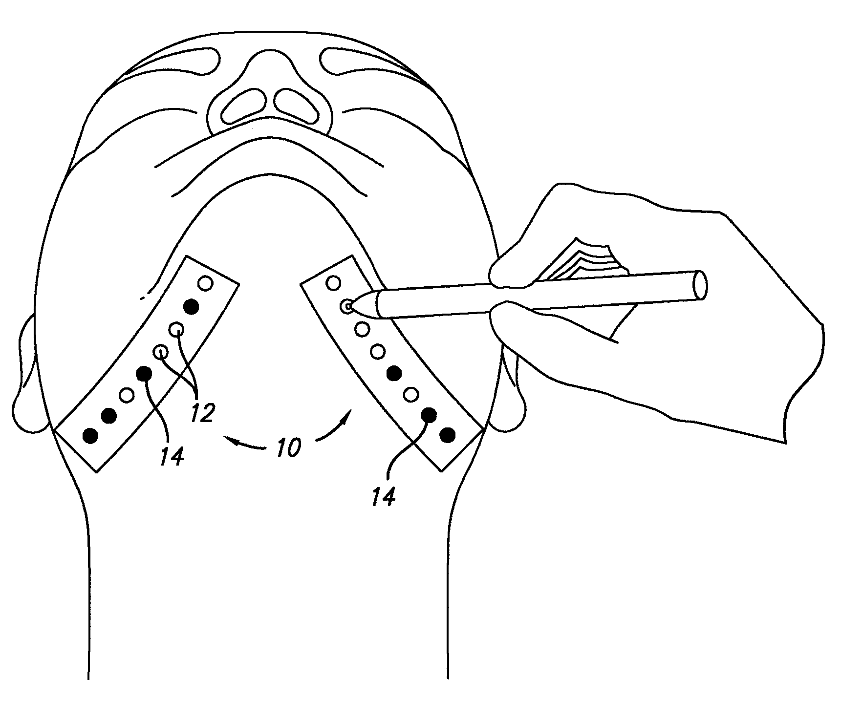 Suture and method for using same