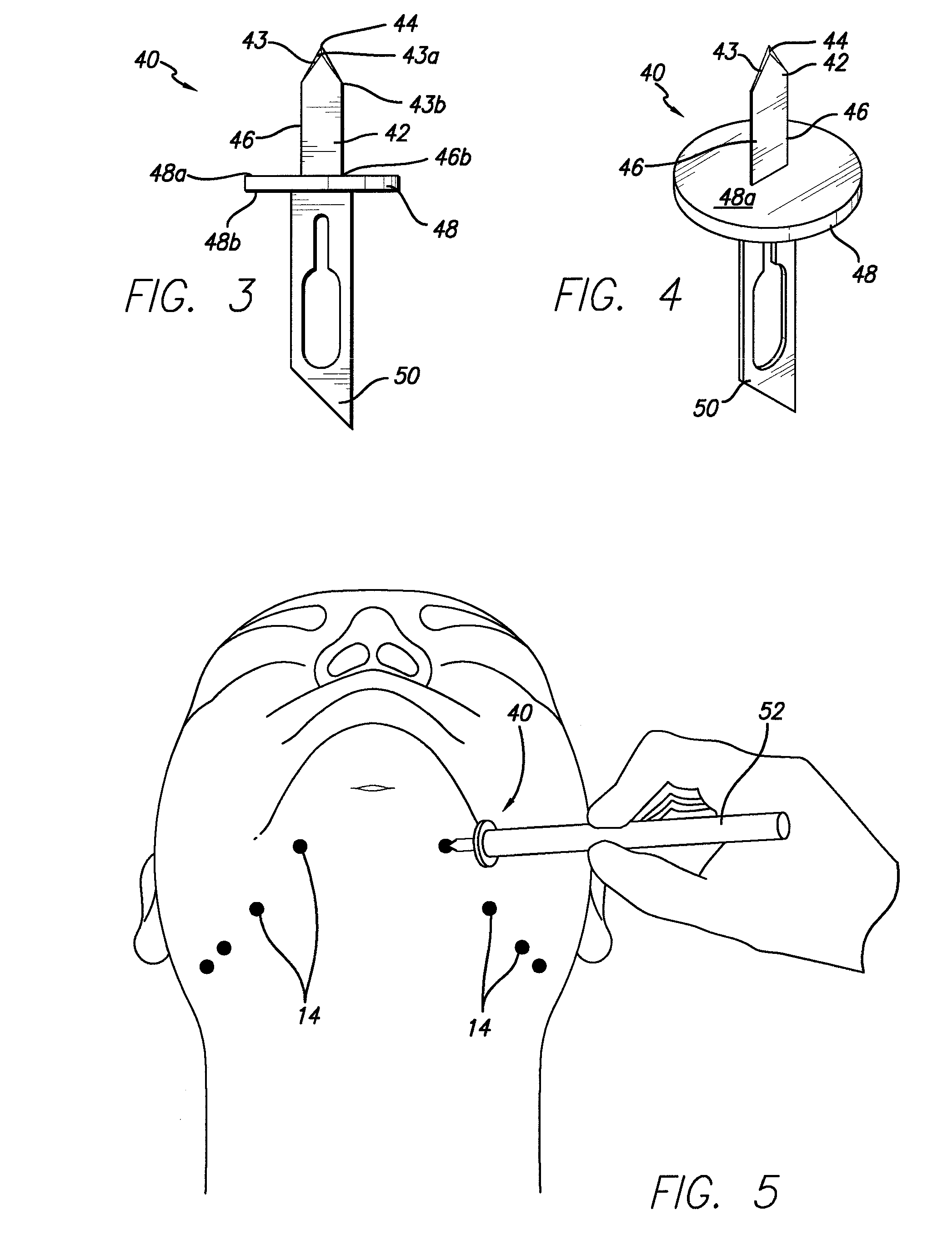 Suture and method for using same