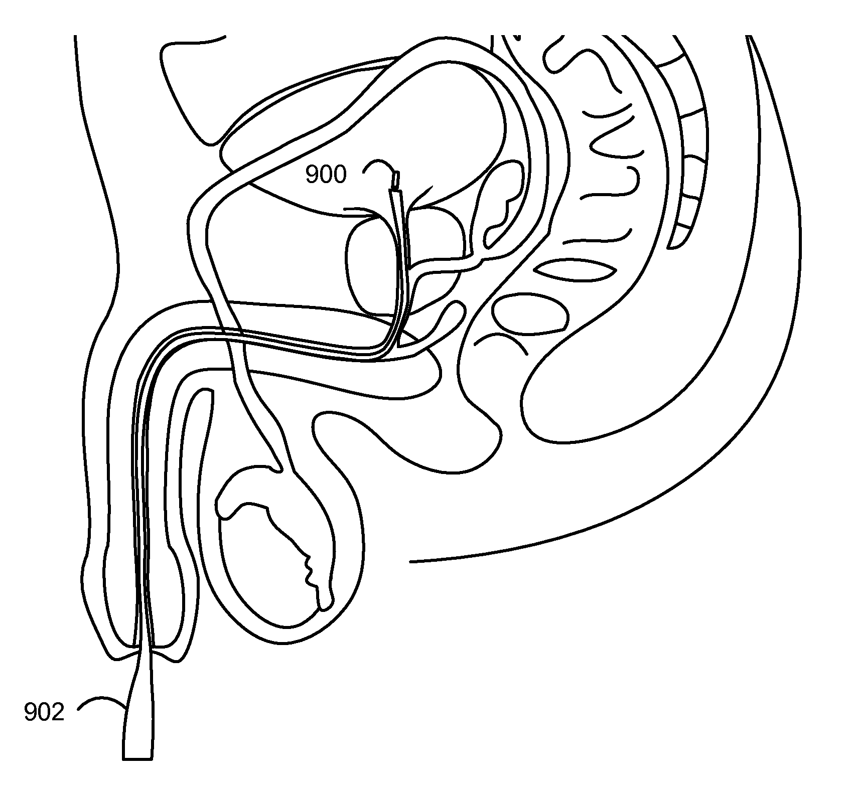 Minimally Invasive Systems and Methods for In Vivo Testing of Materials