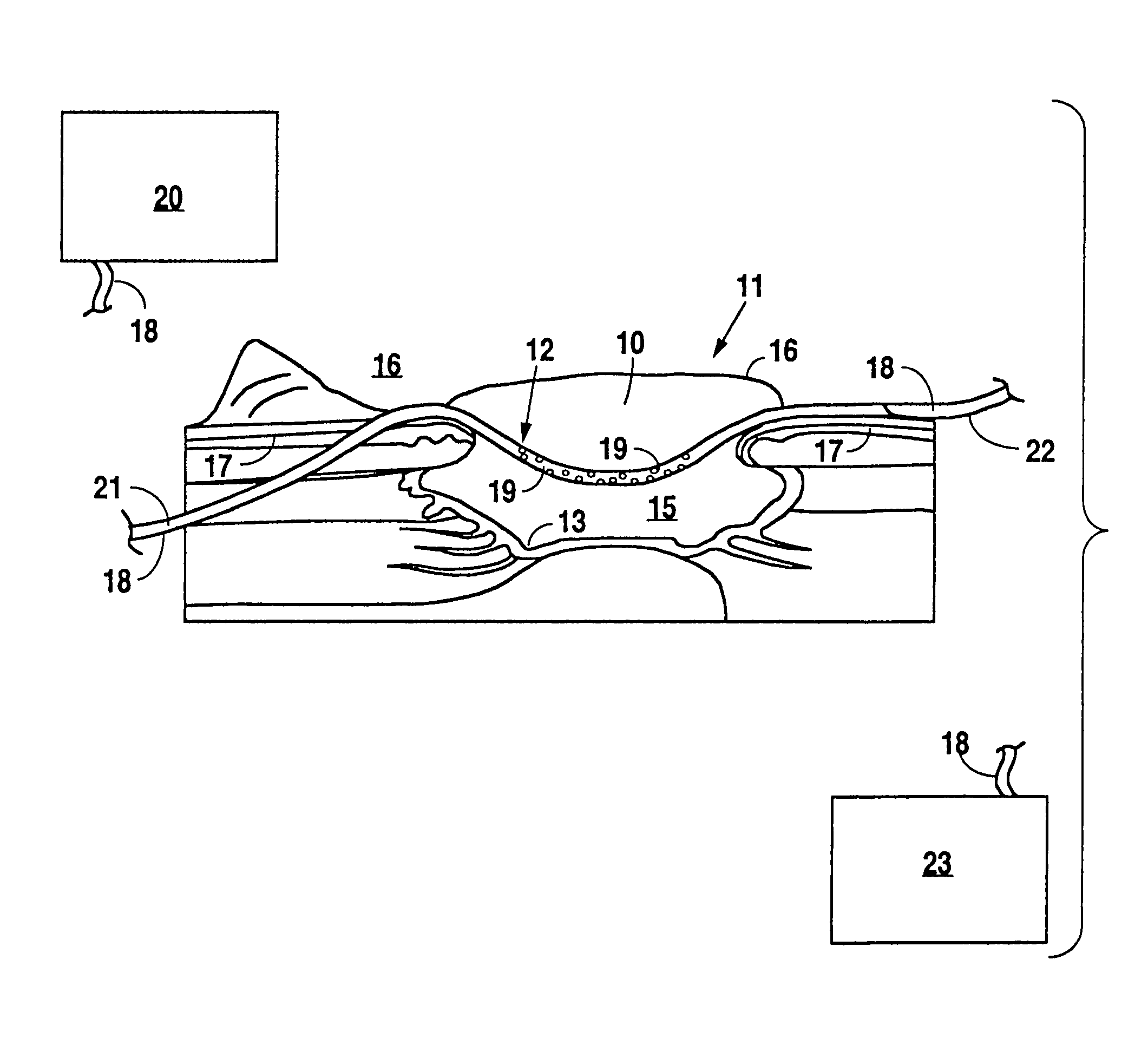 Method and apparatus for wound treatment