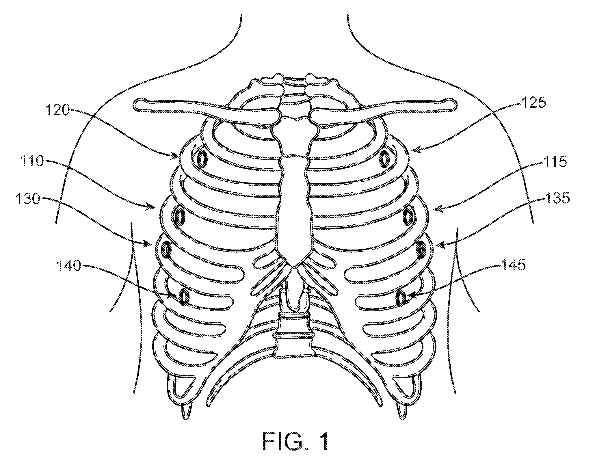 Methods of treating a cardiac arrhythmia by thoracoscopic production of a Cox maze III lesion set