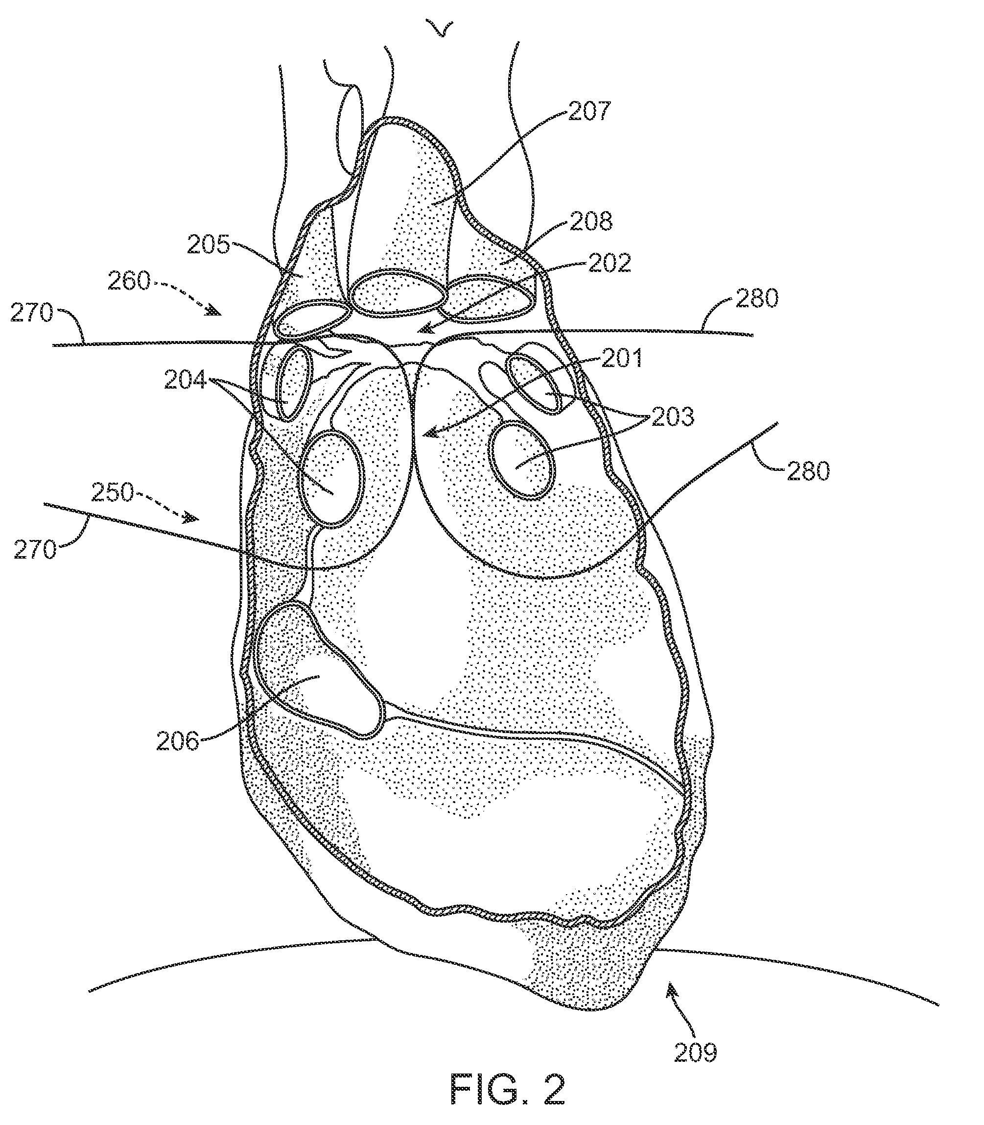 Methods of treating a cardiac arrhythmia by thoracoscopic production of a Cox maze III lesion set