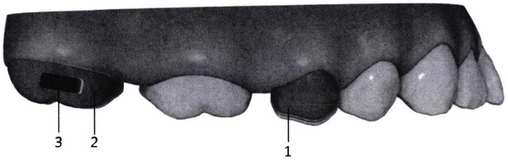 Bracket-free invisible orthodontic appliance produced based on tooth multi-position overlapping model and manufacturing method of bracket-free invisible orthodontic appliance