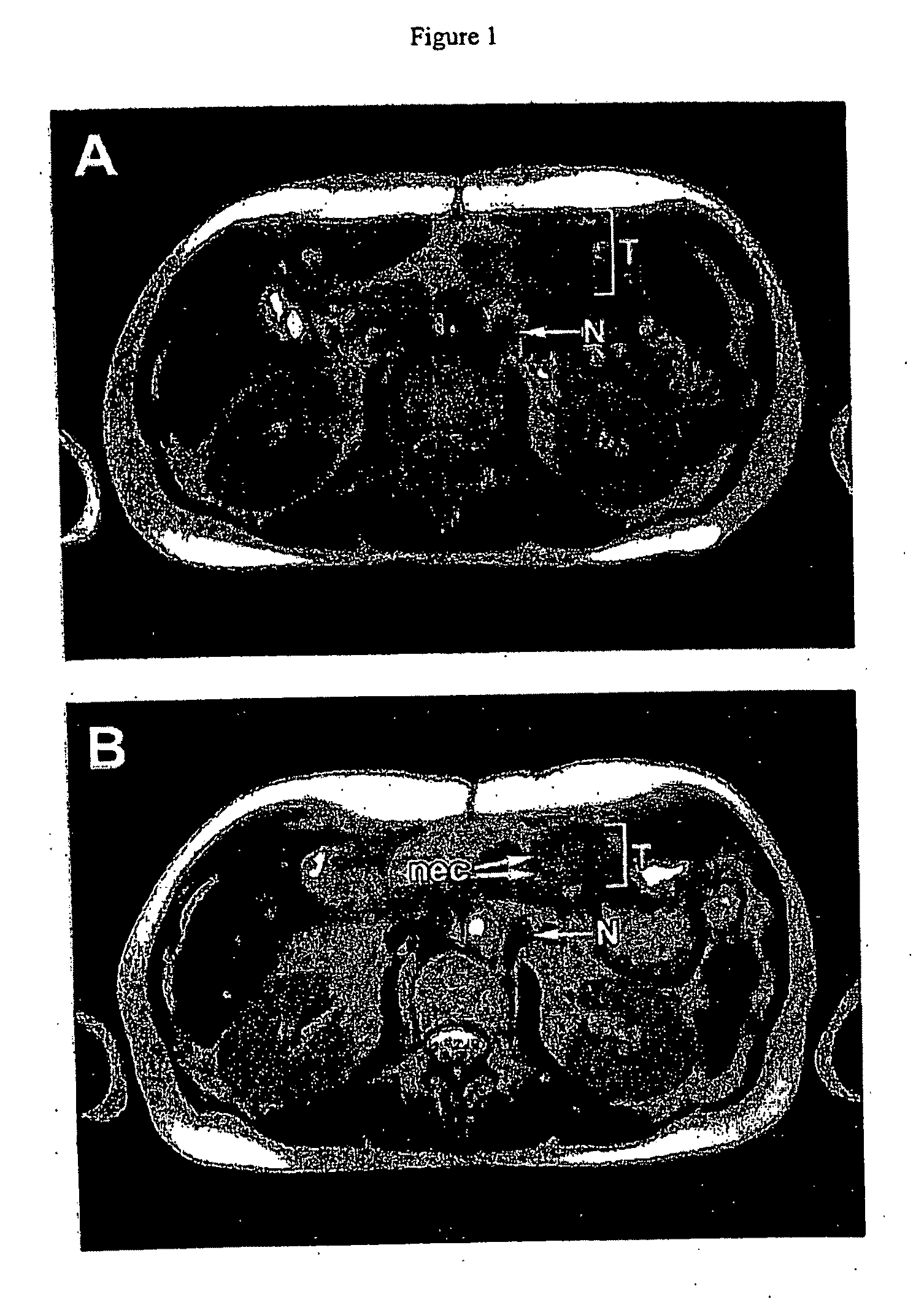 Pathotropic targeted gene delivery system for cancer and other disorders