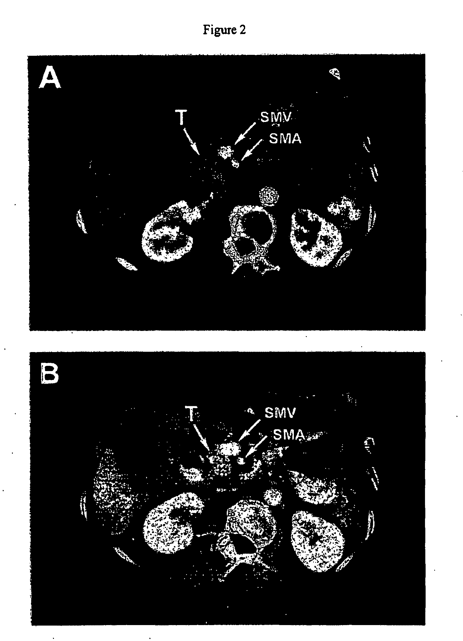 Pathotropic targeted gene delivery system for cancer and other disorders