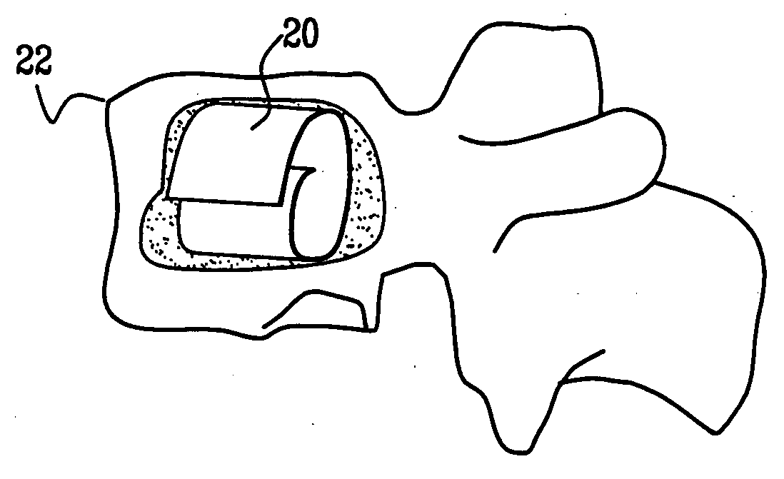 Device and method for treating compression fractures