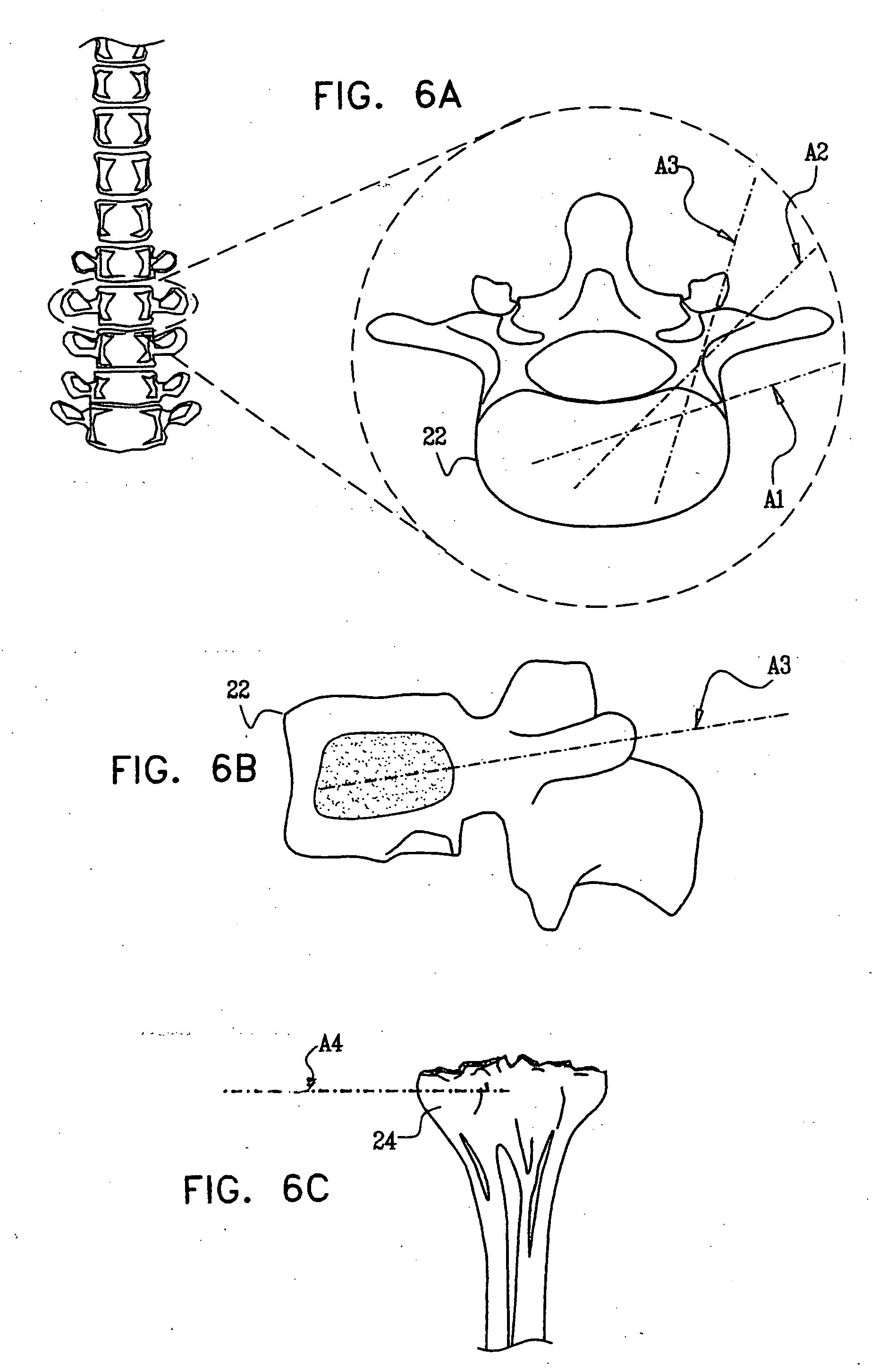 Device and method for treating compression fractures