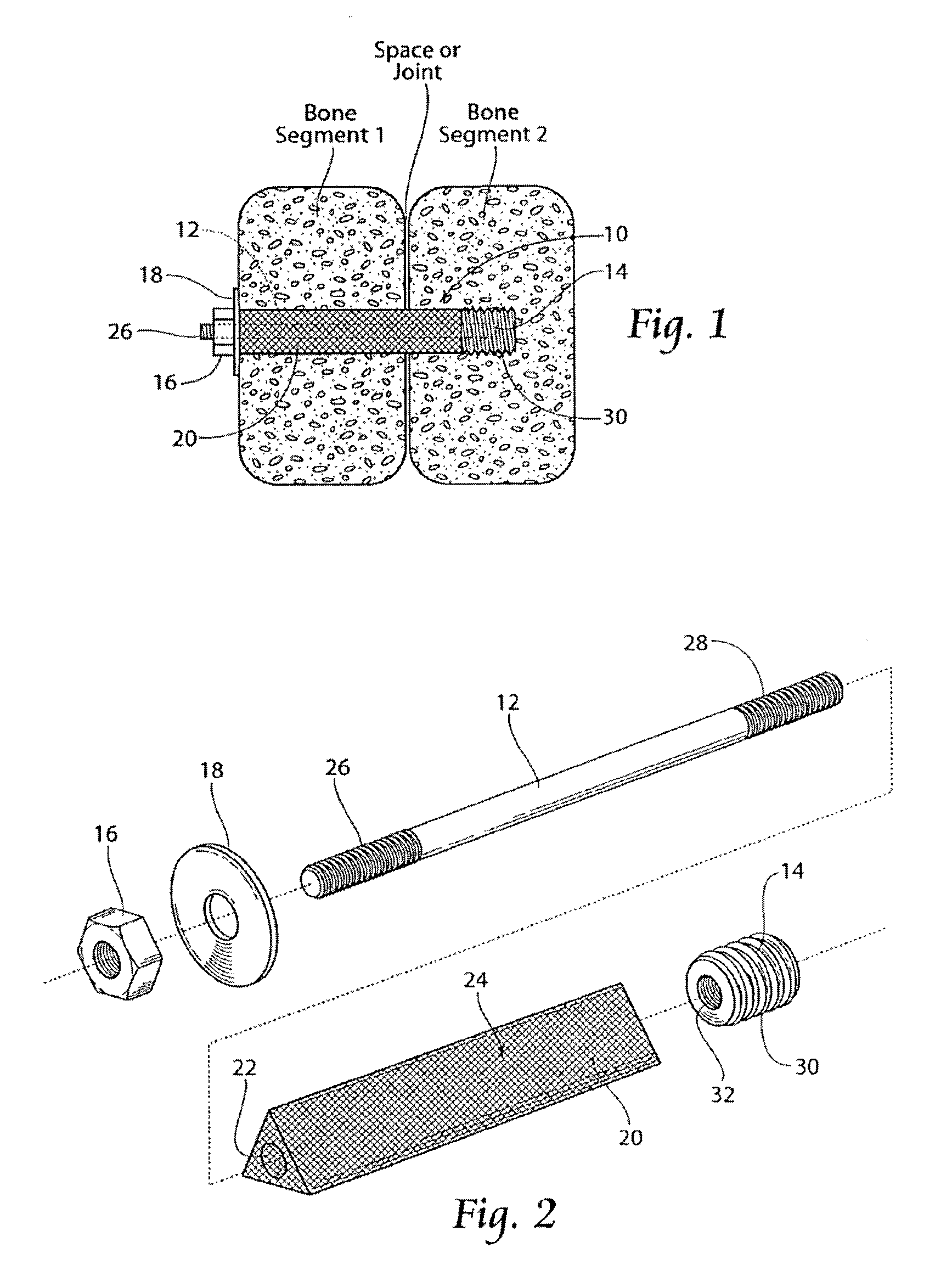 Apparatus, systems, and methods for the fixation or fusion of bone