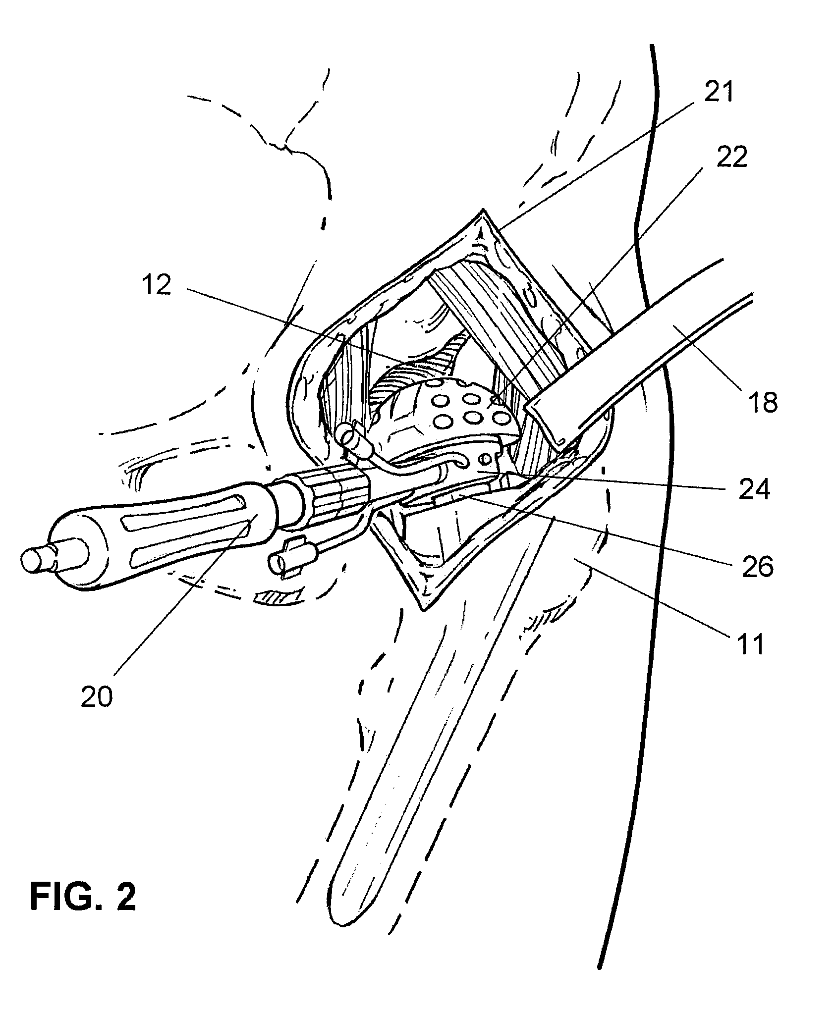 Apparatus and method for minimally invasive total joint replacement