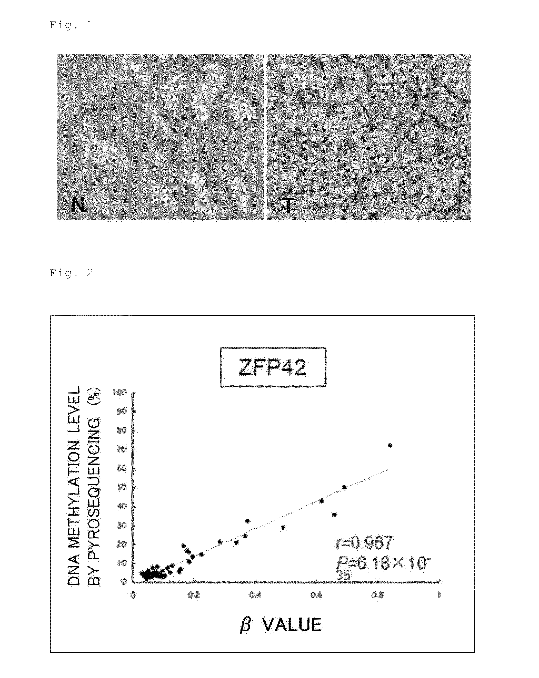 Method for predicting prognosis of renal cell carcinoma