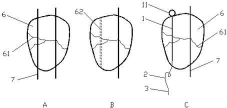 Pressurization needle cable fixed system for patella fracture and application thereof