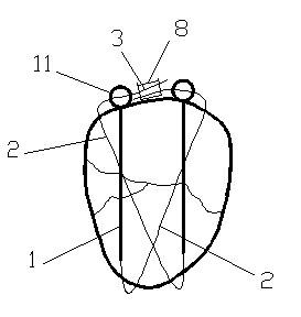 Pressurization needle cable fixed system for patella fracture and application thereof