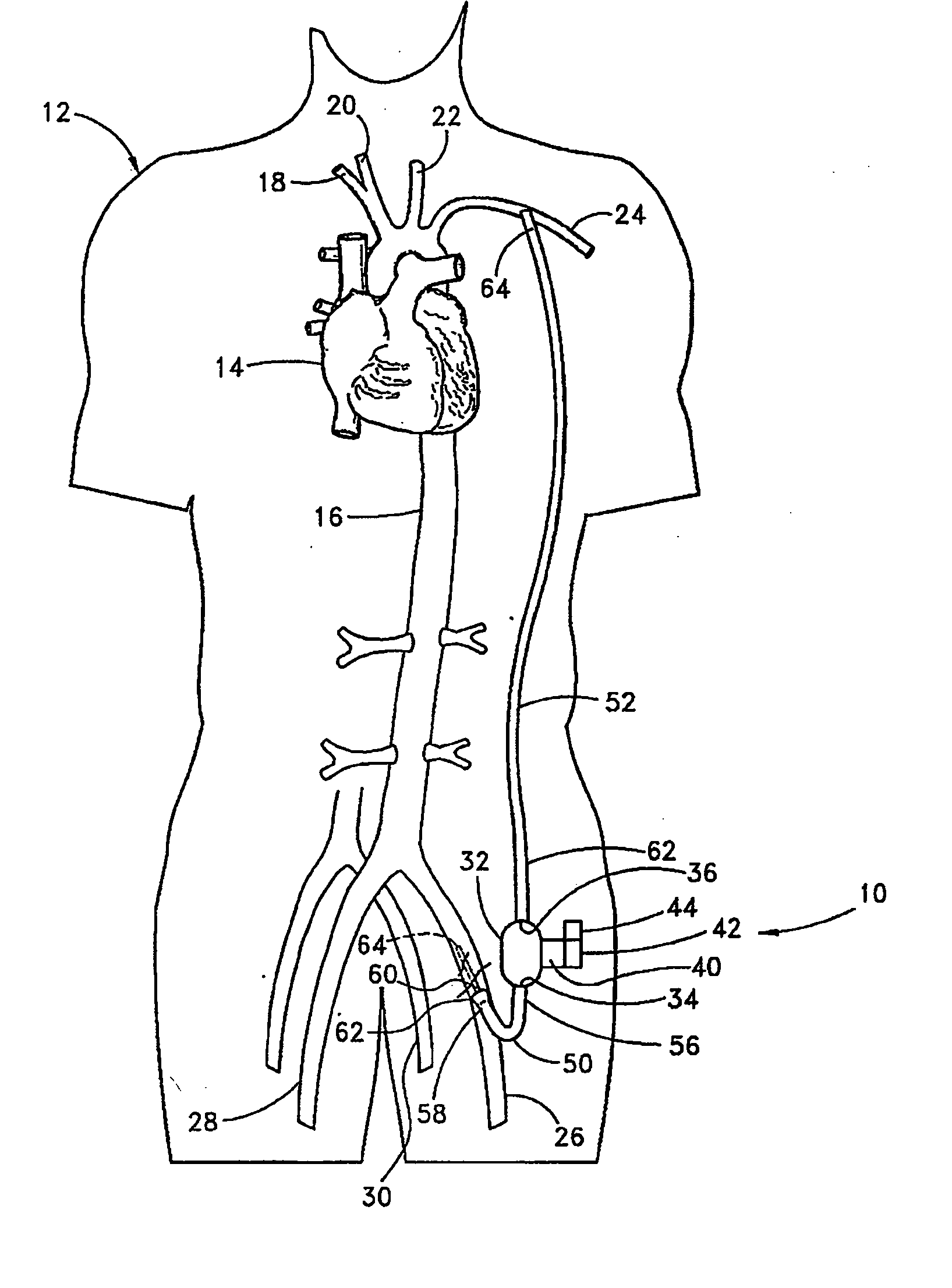 Implantable heart assist system and method of applying same