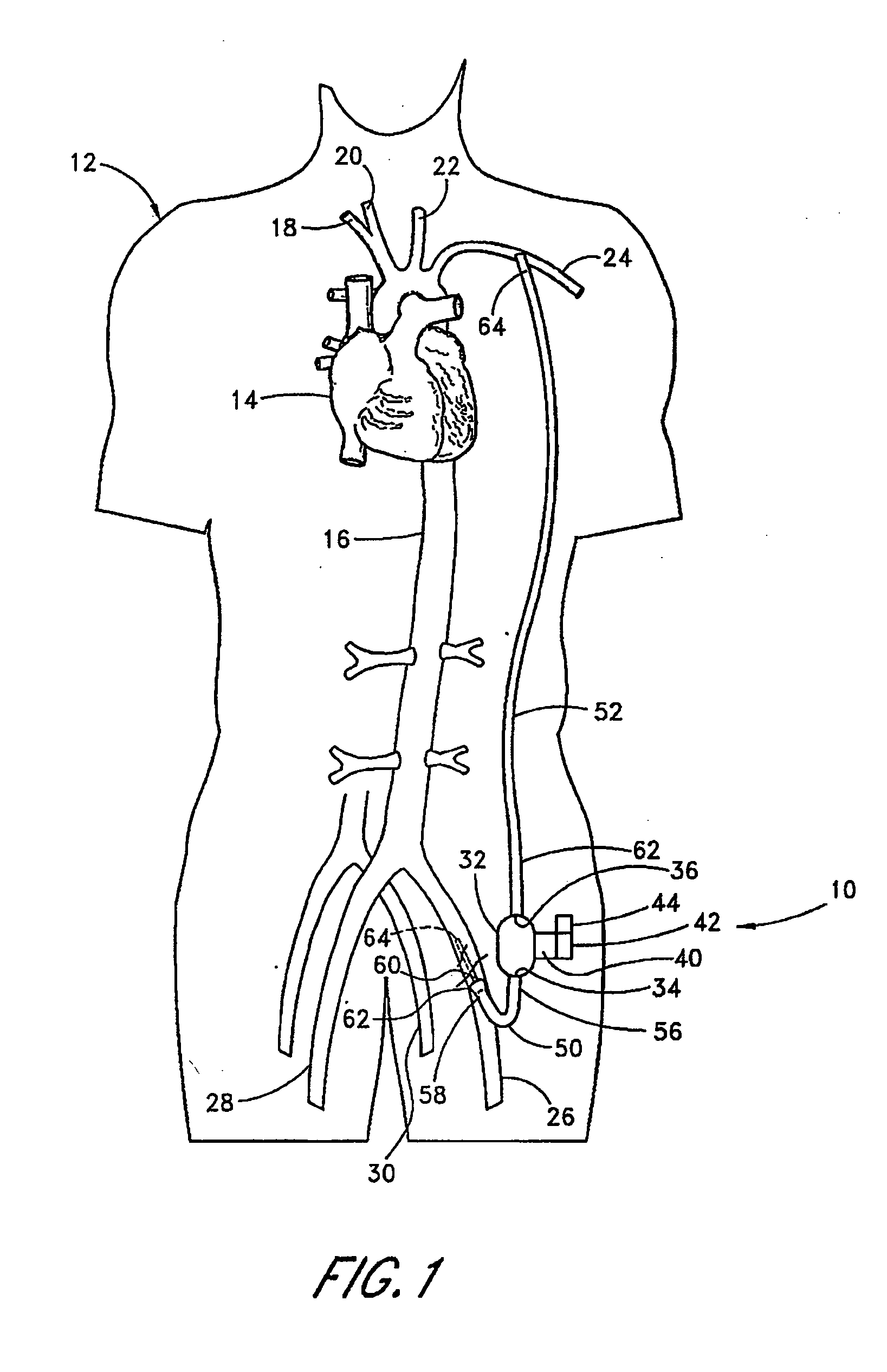 Implantable heart assist system and method of applying same