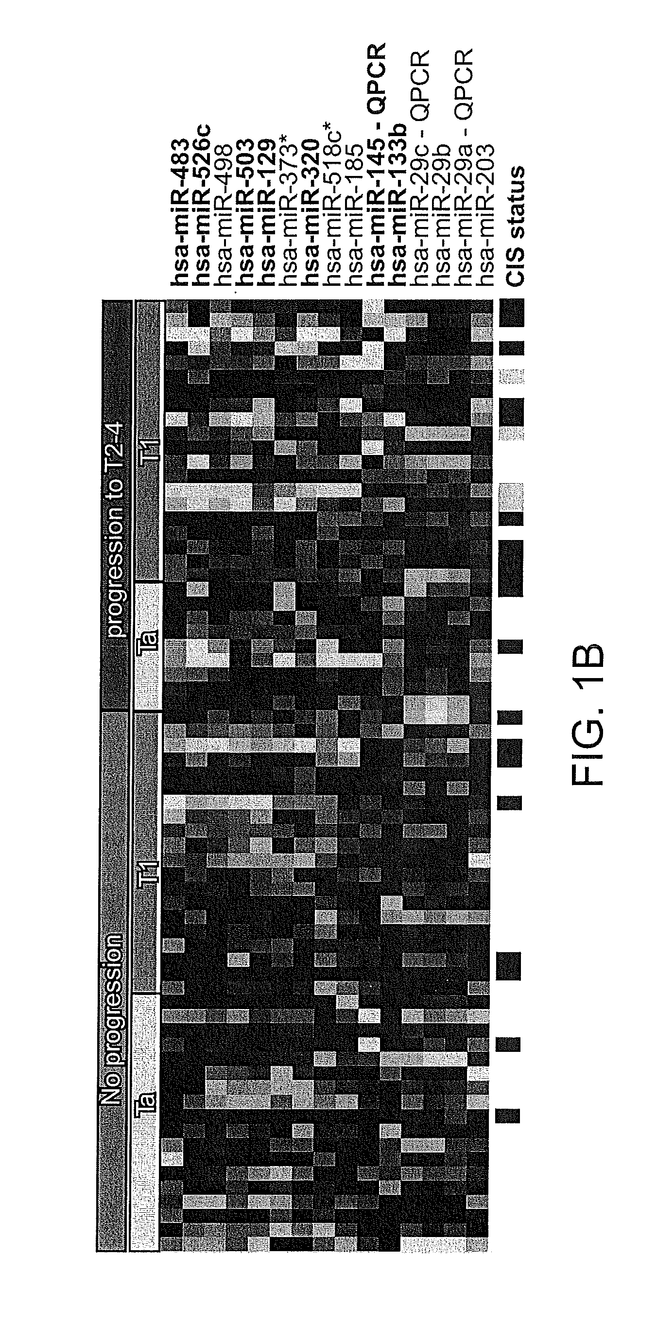 Diagnostic and prognostic use of human bladder cancer-associated micro rnas