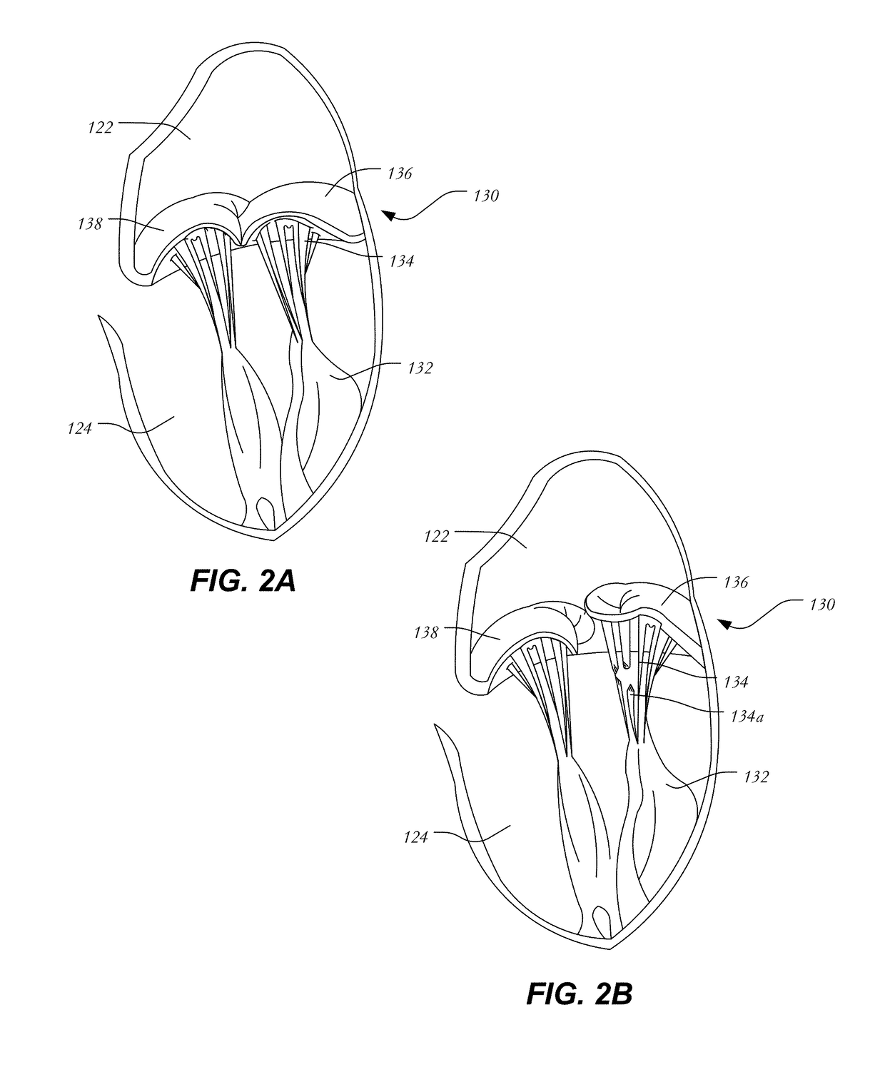 Mitral heart valve replacement