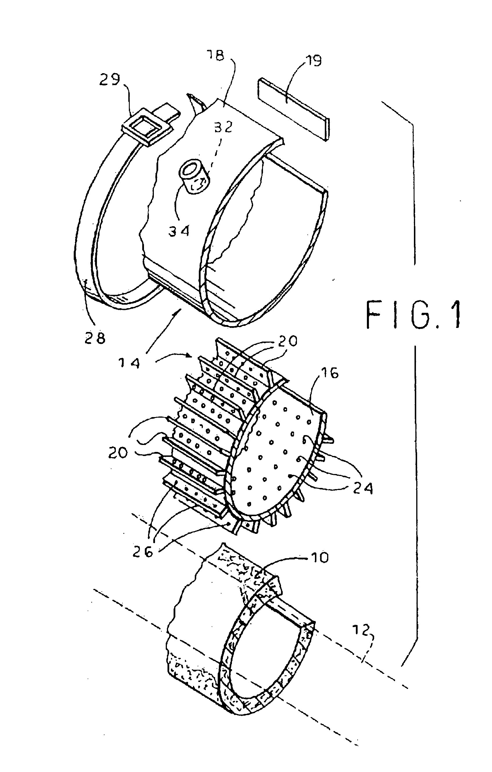 External left ventricular assist device for treatment of congestive heart failure