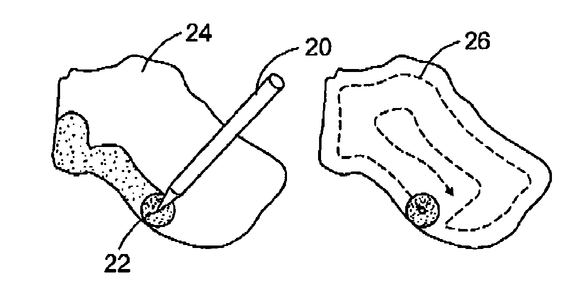 System and methods for using a dynamic scheme for radiosurgery