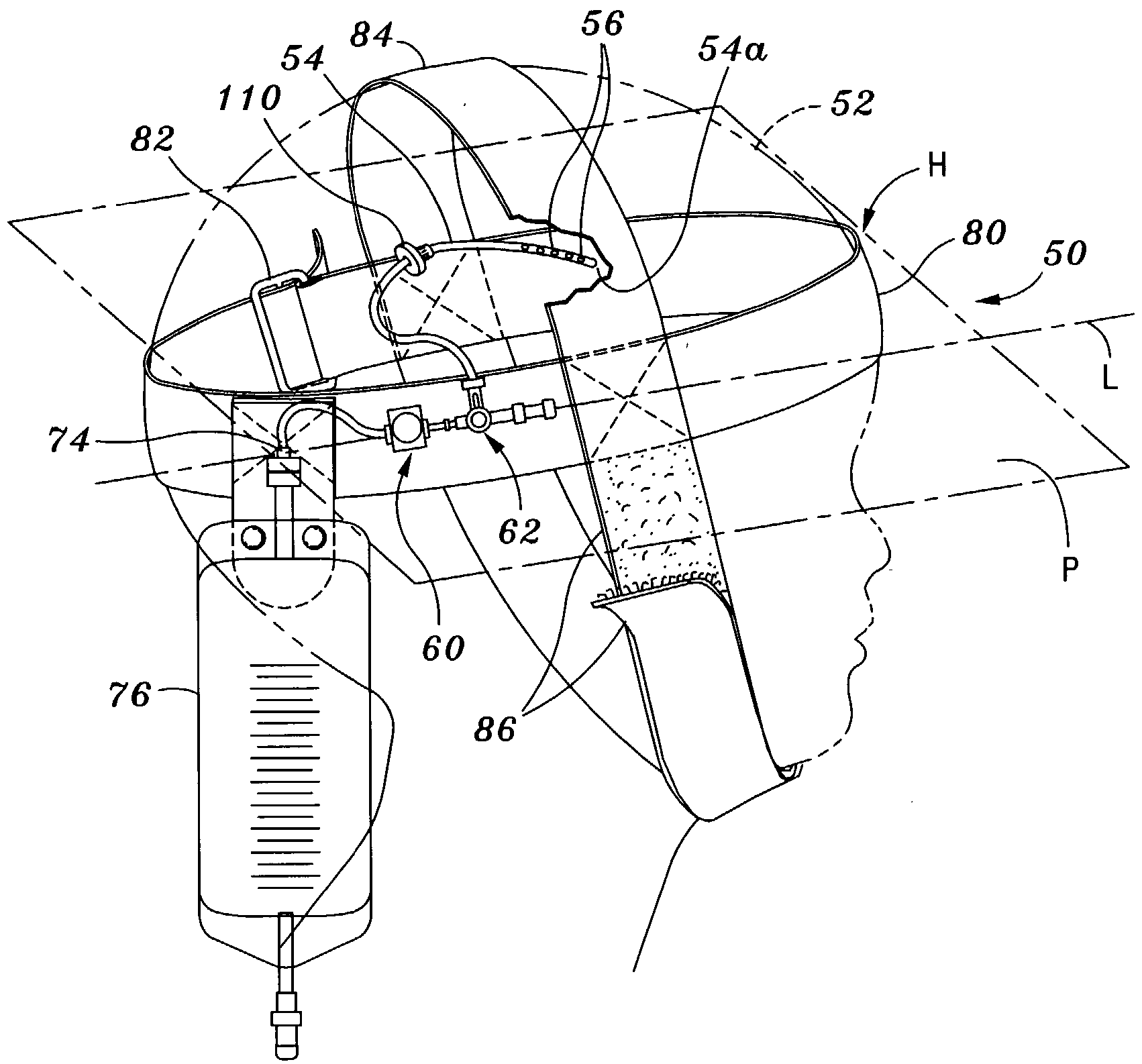 Portable pressure relief system & methods