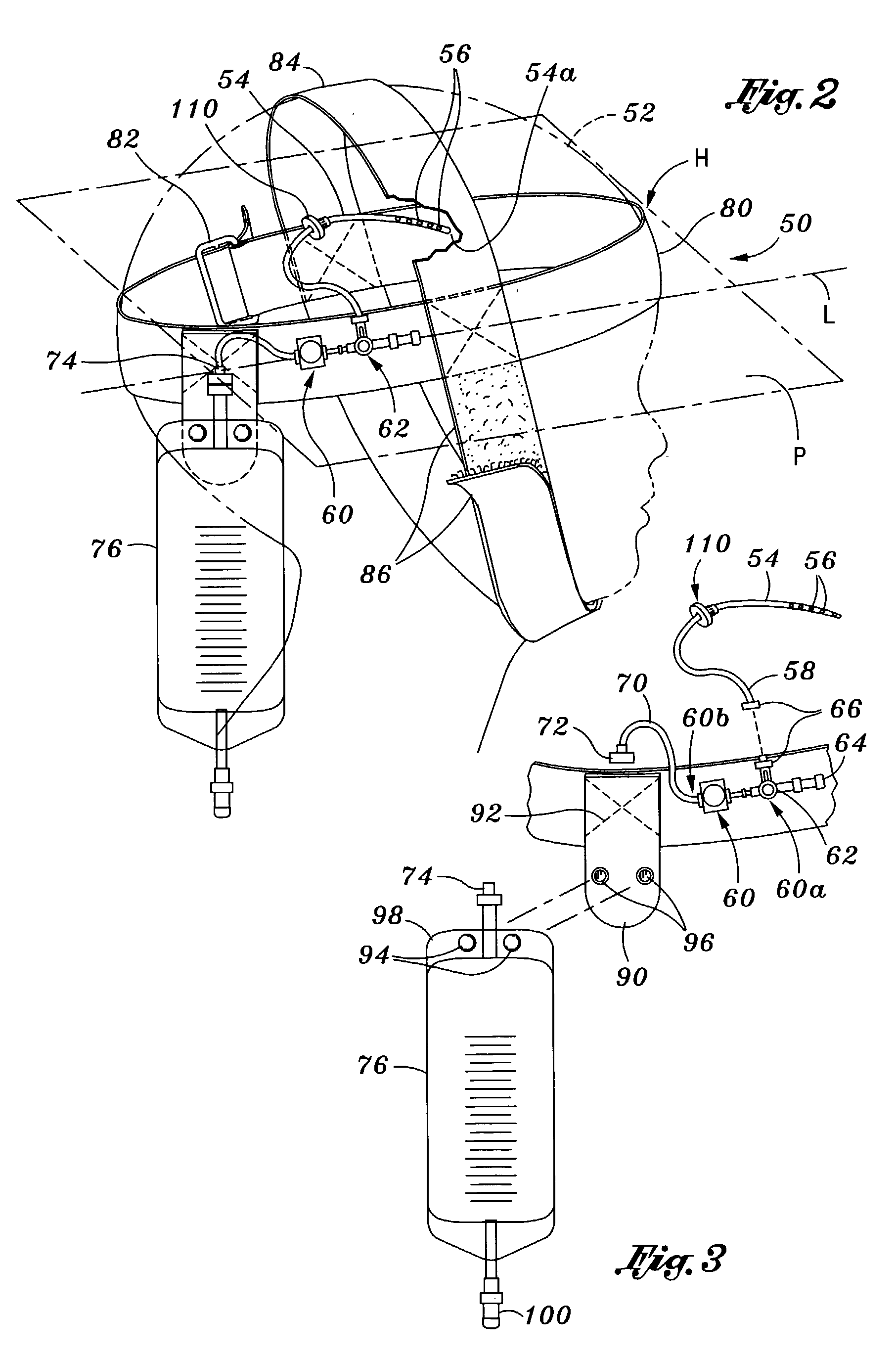 Portable pressure relief system & methods