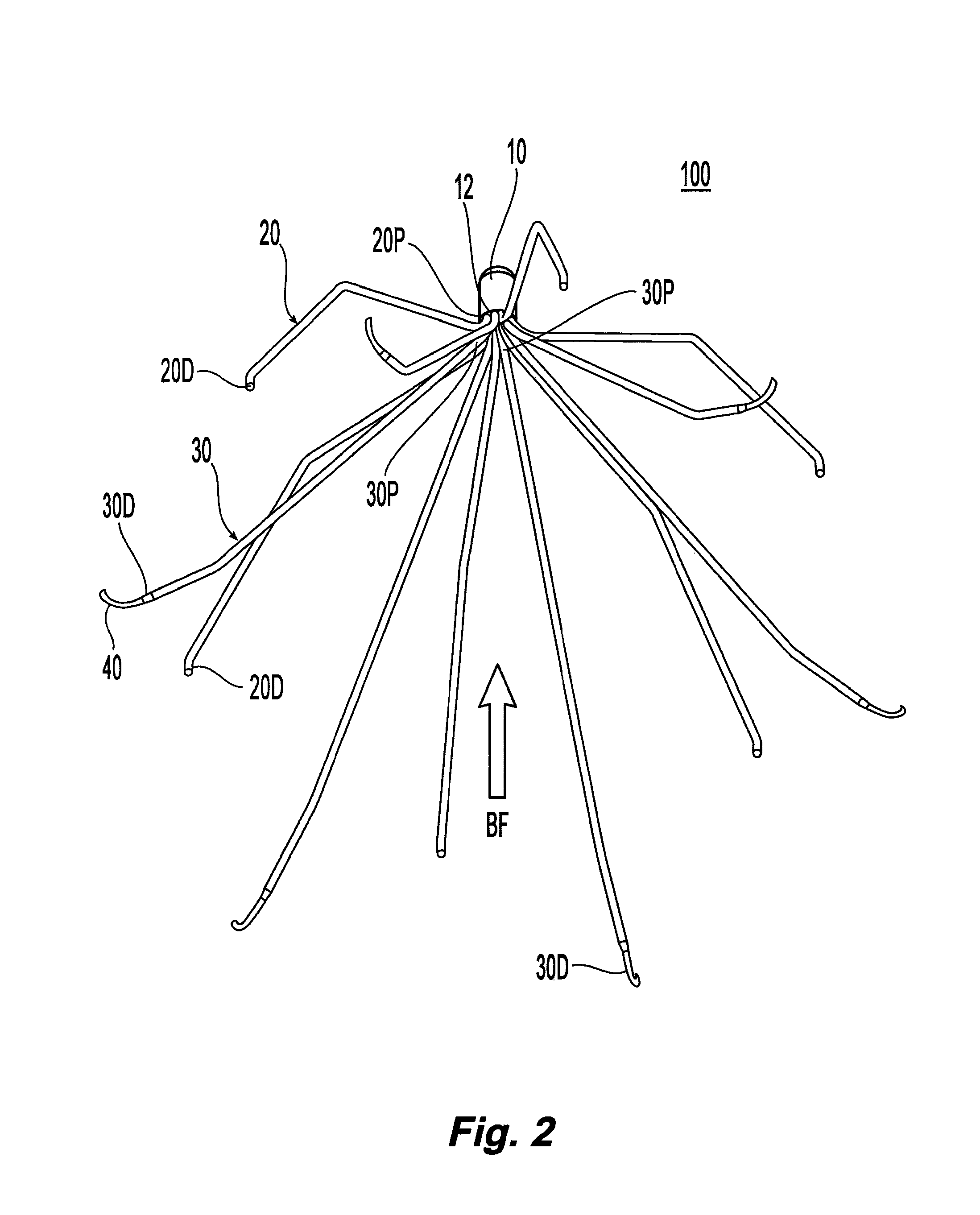 Removable blood clot filter with edge for cutting through the endothelium