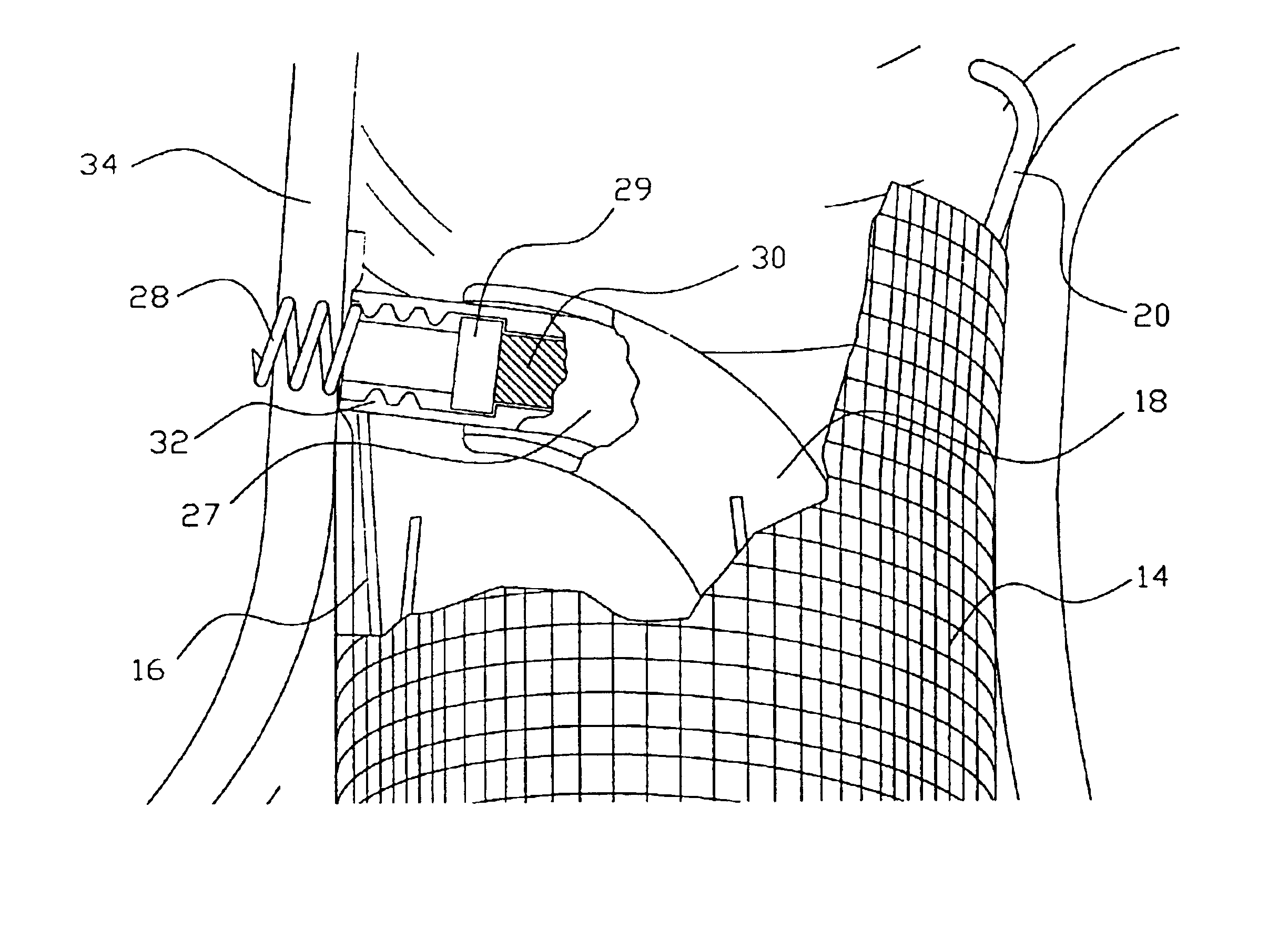 Endovascular aneurysm repair system