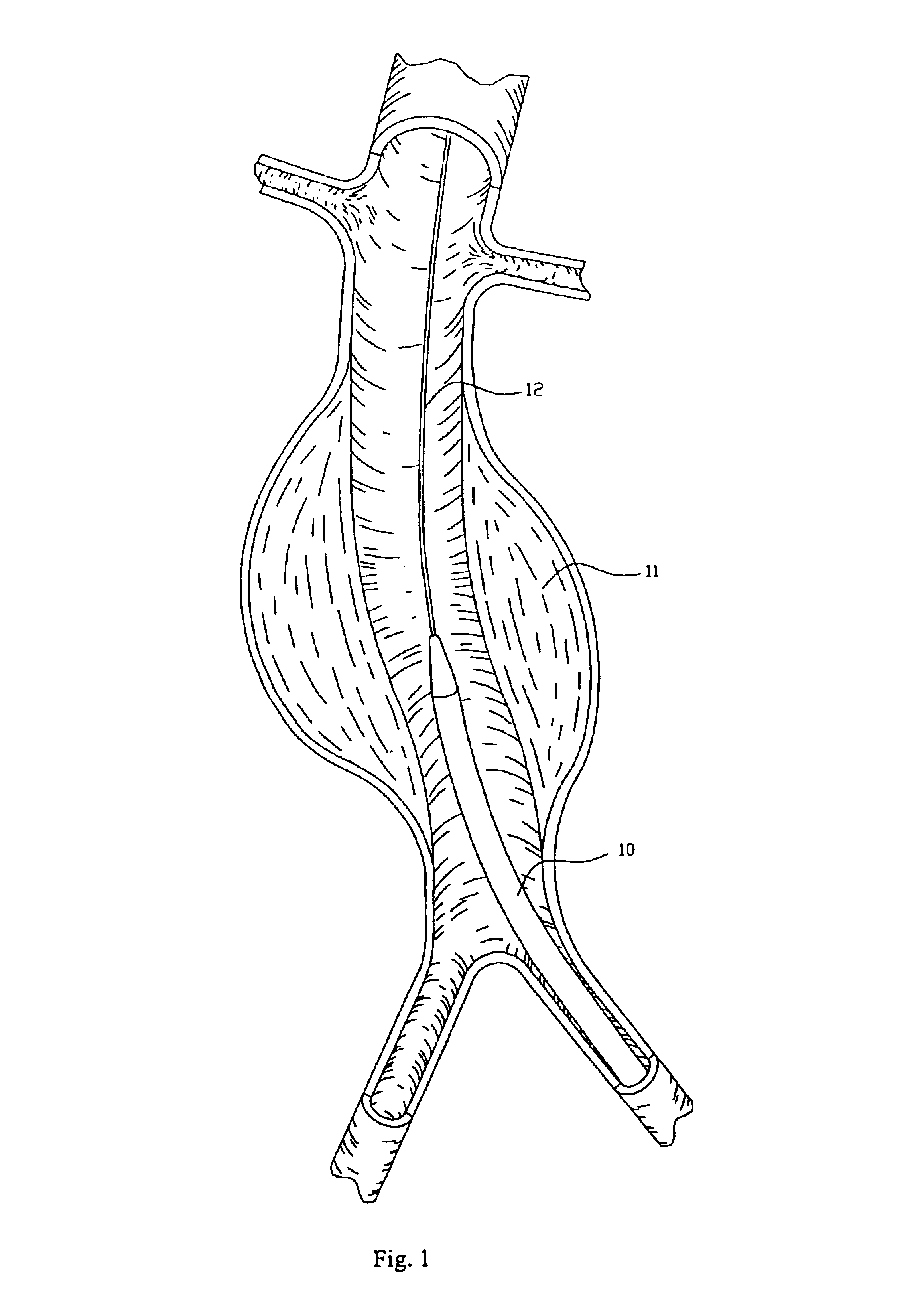 Endovascular aneurysm repair system