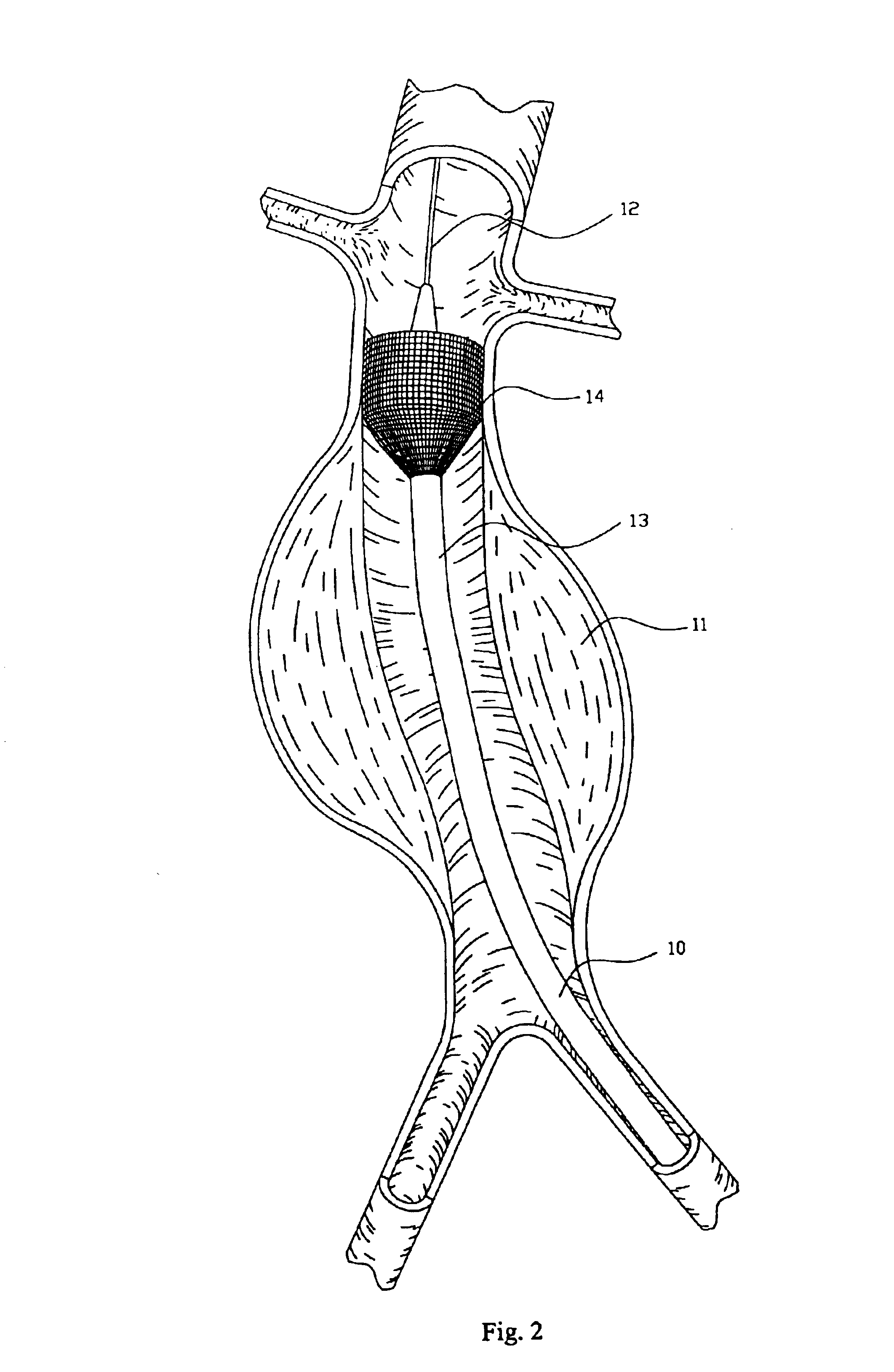 Endovascular aneurysm repair system