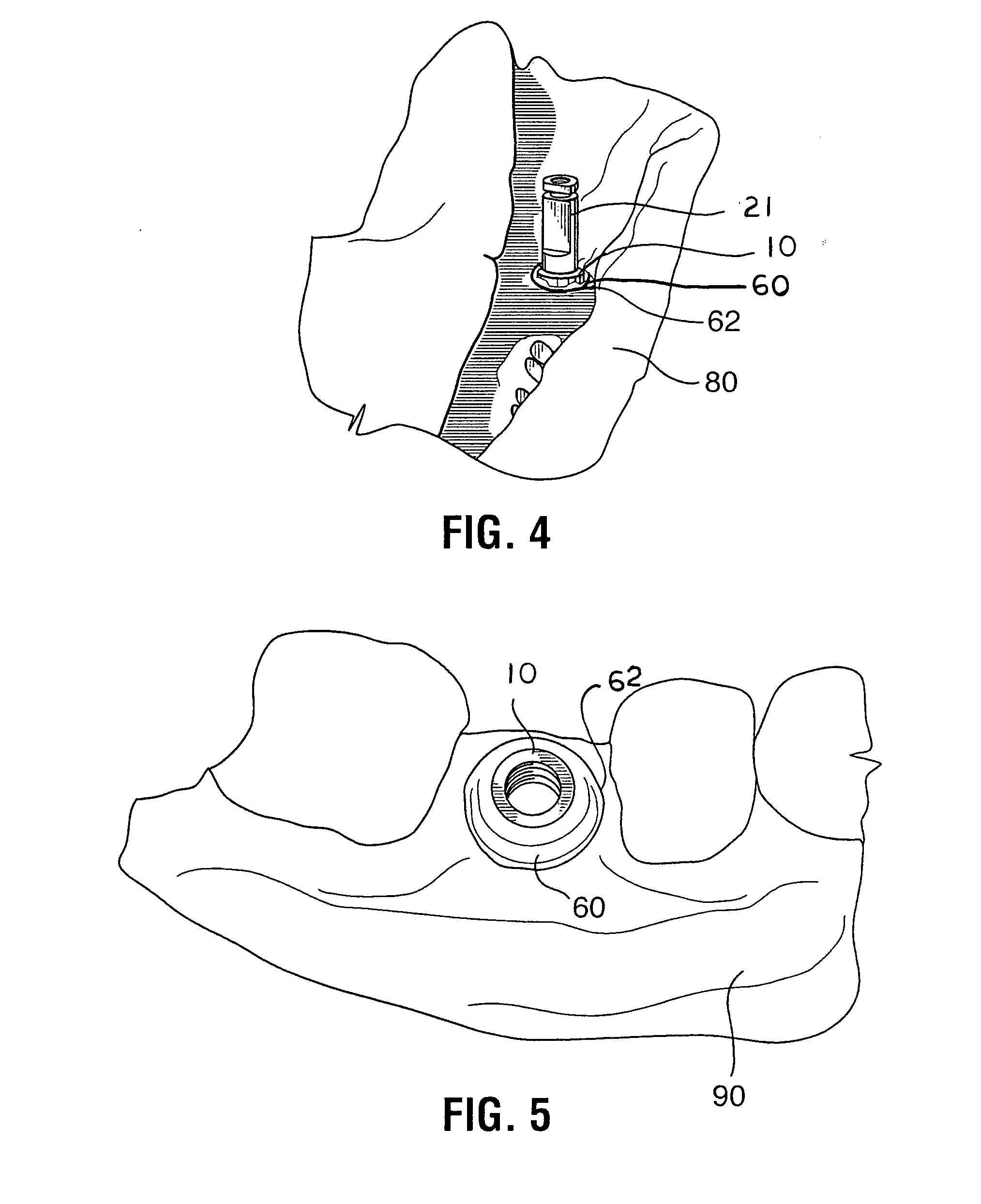 Soft tissue models and method of making for dental implant applications