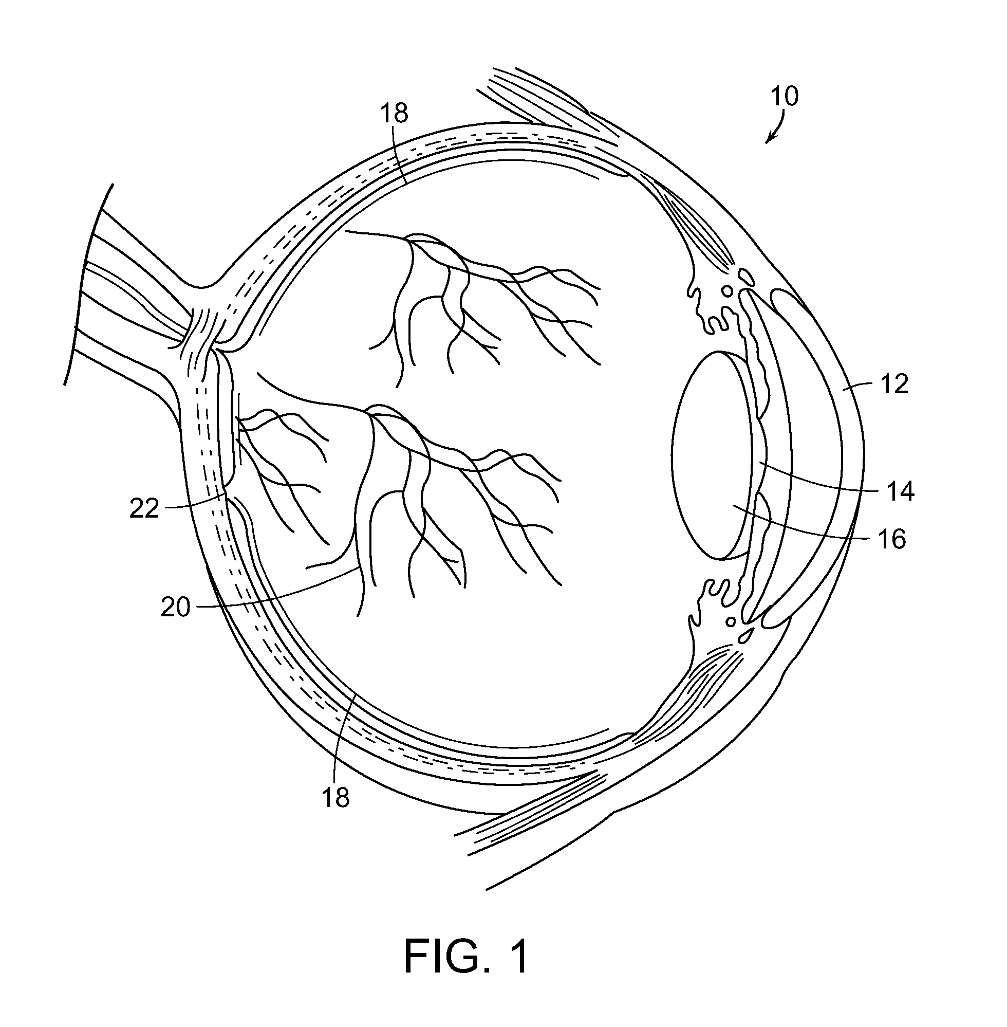 Subthreshold micropulse laser prophylactic treatment for chronic progressive retinal diseases