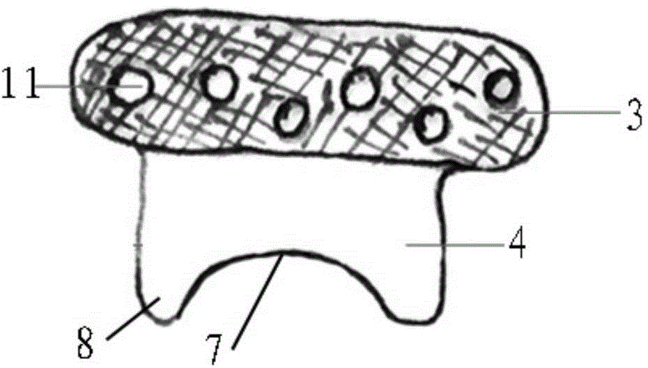 Artificial temporal-mandibular joint replacement prosthesis