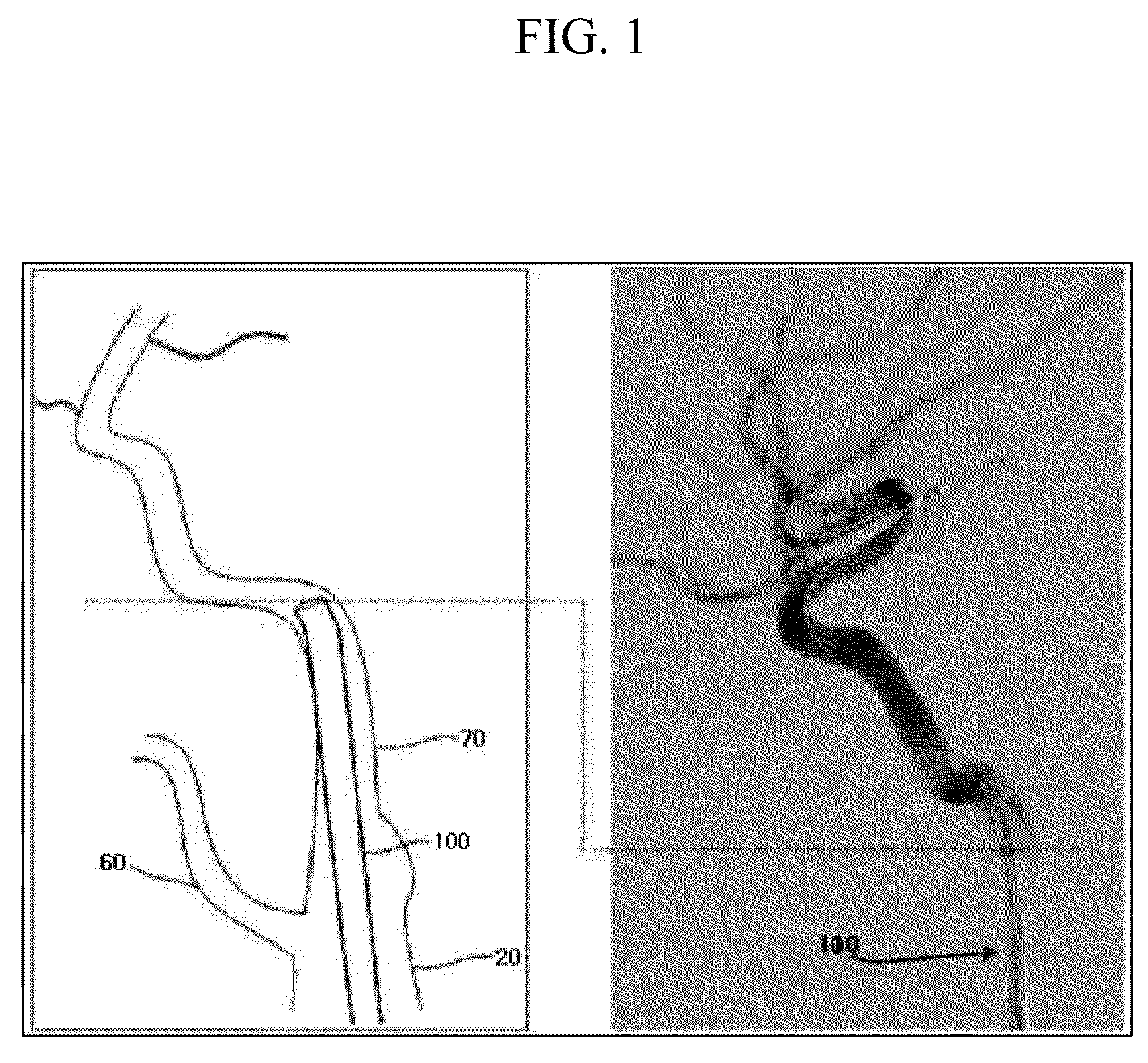 Distal part guiding catheter