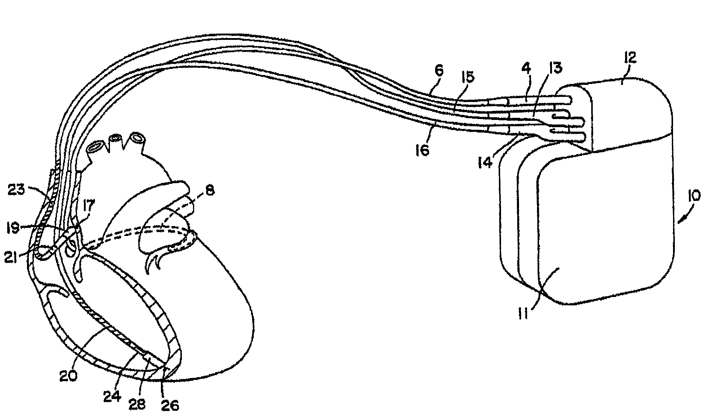 Method and apparatus for identifying cardiac and non-cardiac oversensing using intracardiac electrograms