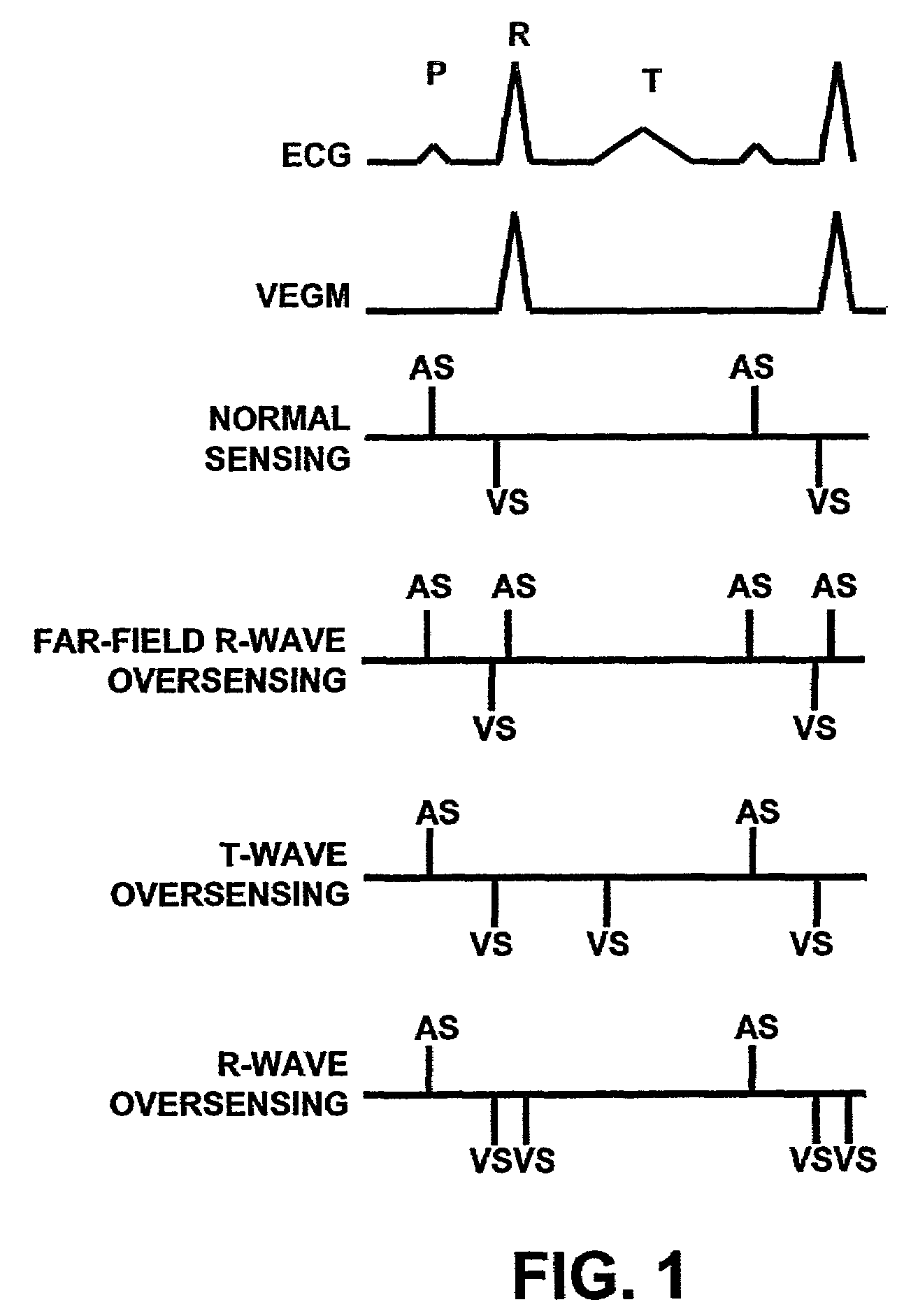 Method and apparatus for identifying cardiac and non-cardiac oversensing using intracardiac electrograms