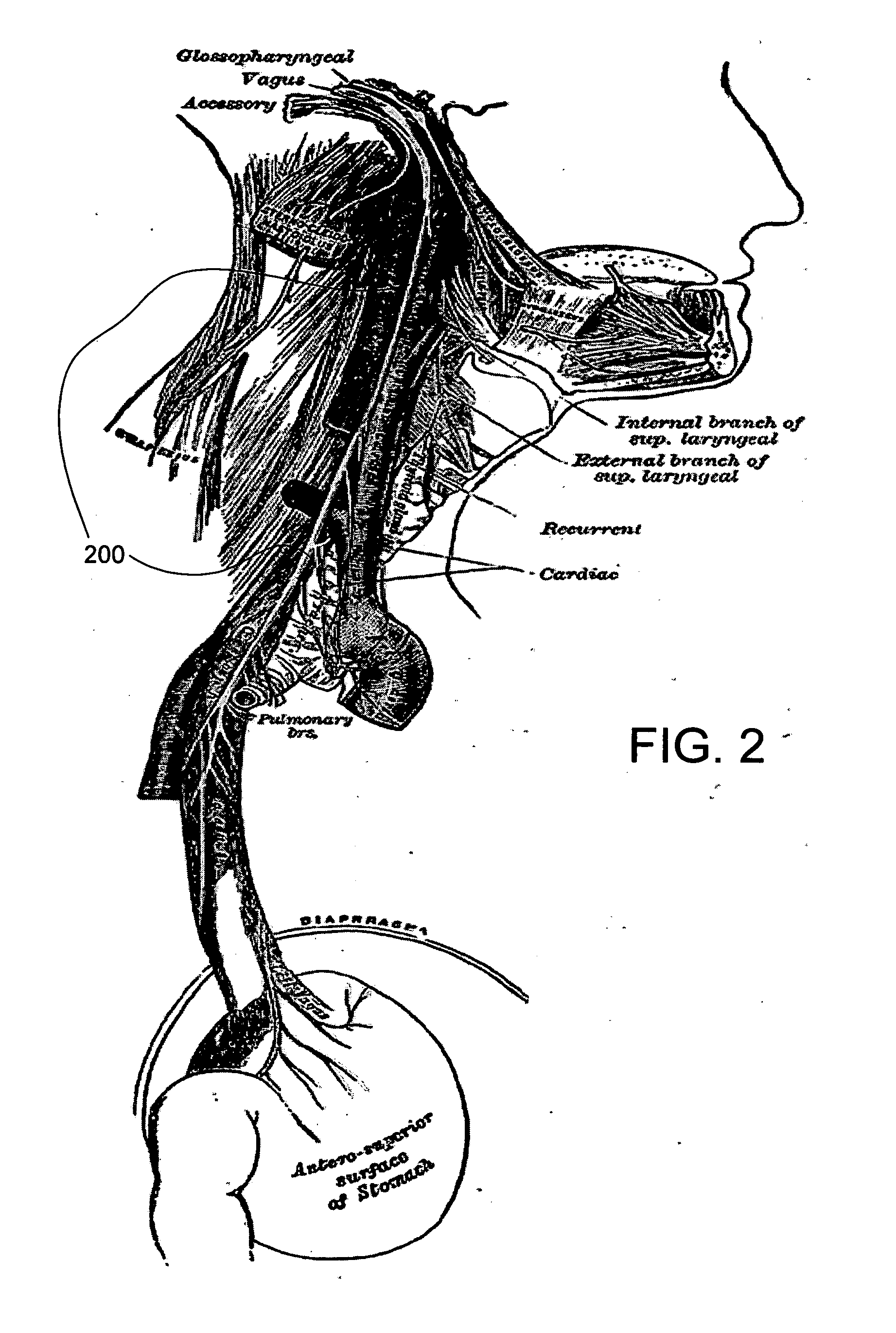 Electrical stimulation treatment of bronchial constriction