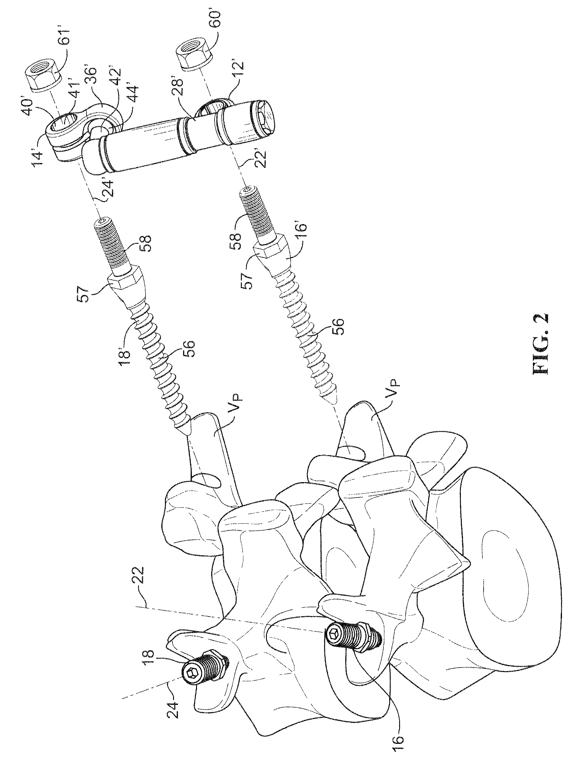 Posterior lumbar joint prosthesis