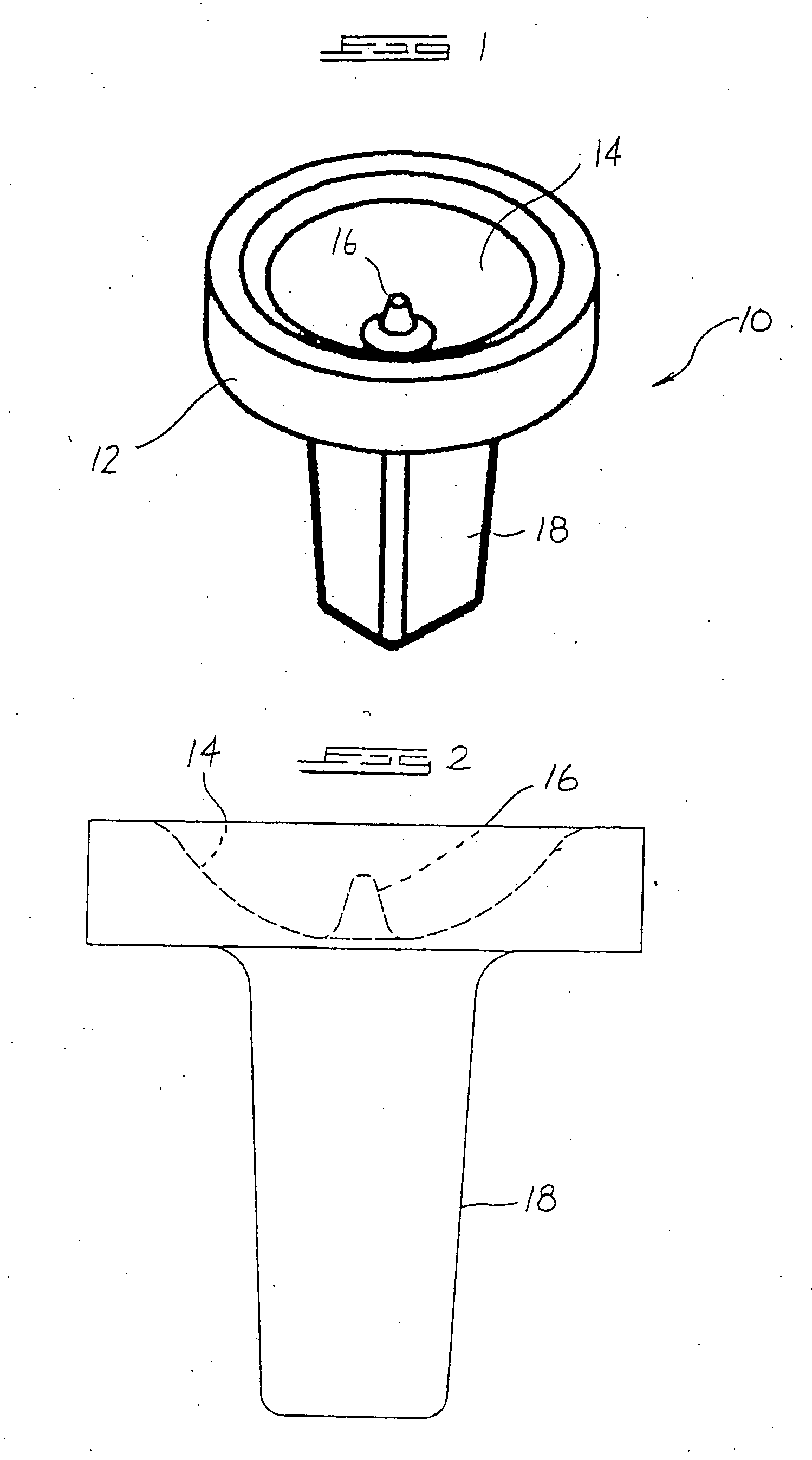 Arthroplasty implant