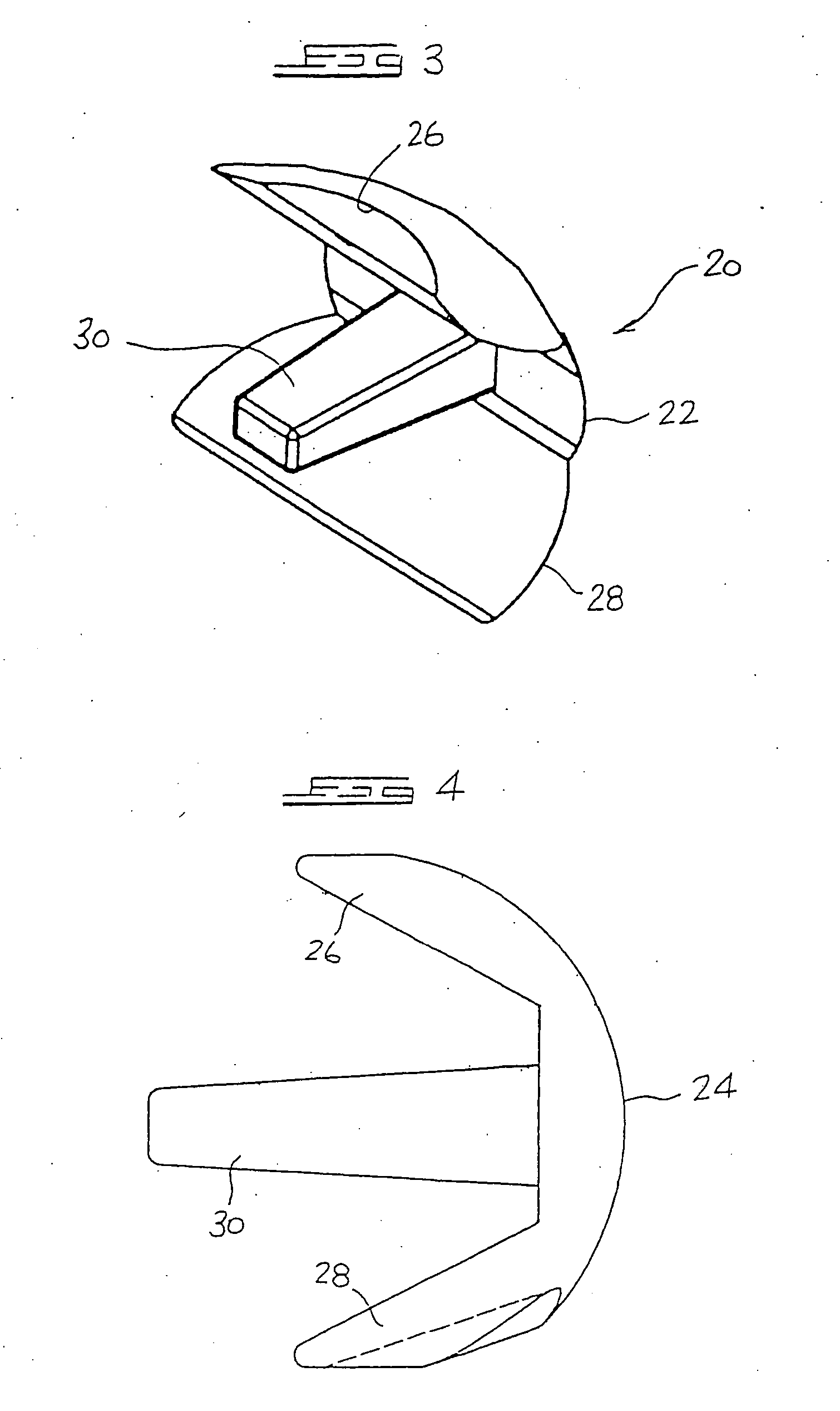 Arthroplasty implant