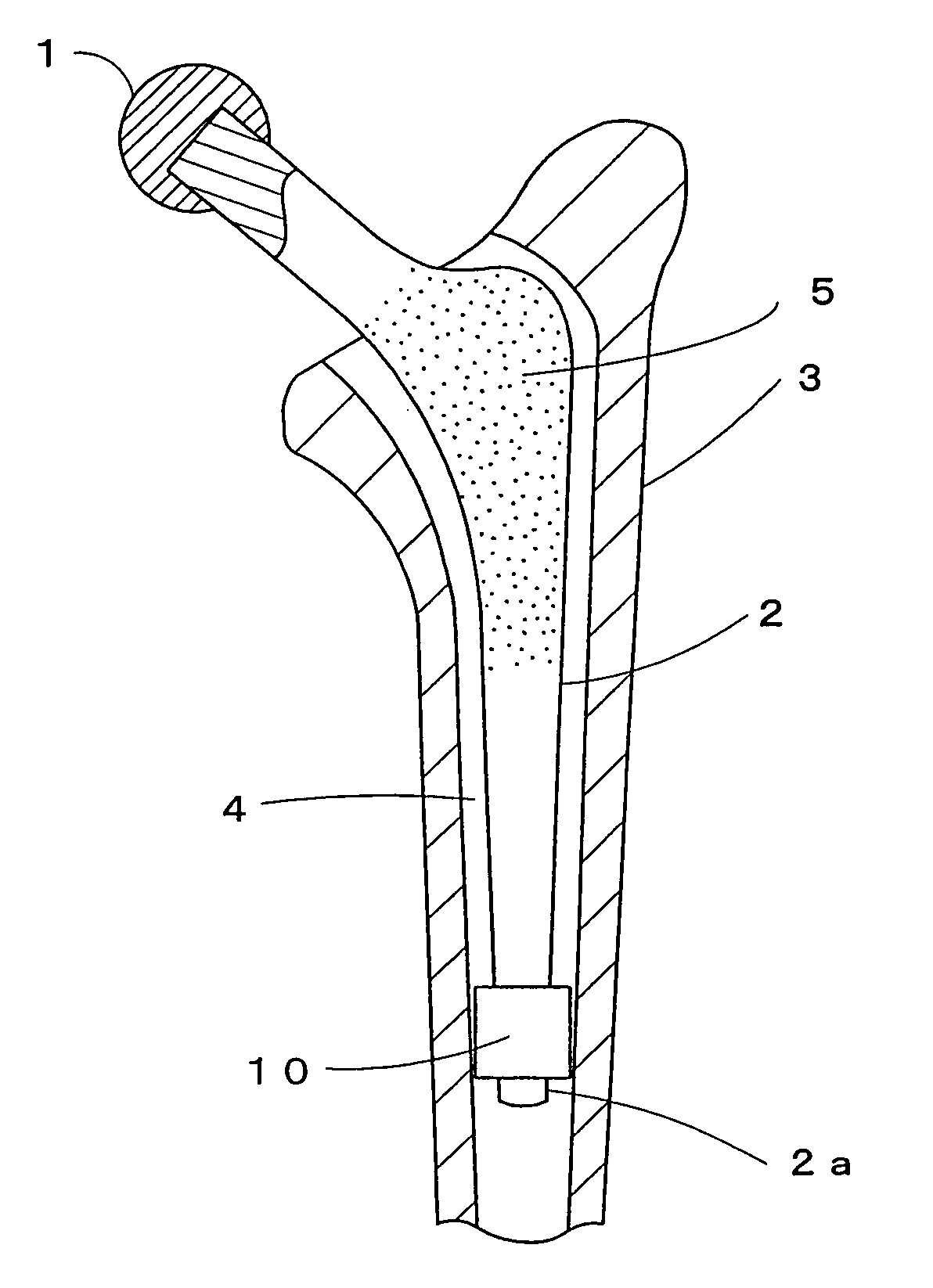 Distal tip for the positioning of artificial joint stem