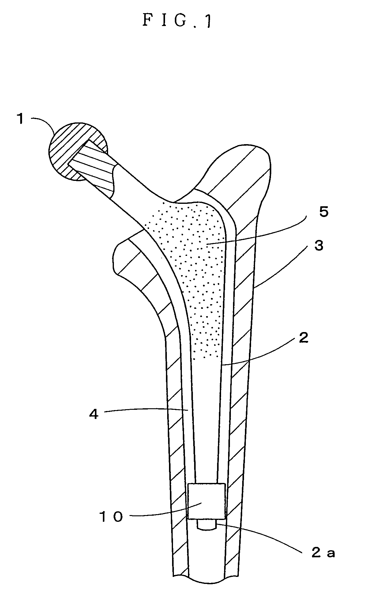 Distal tip for the positioning of artificial joint stem