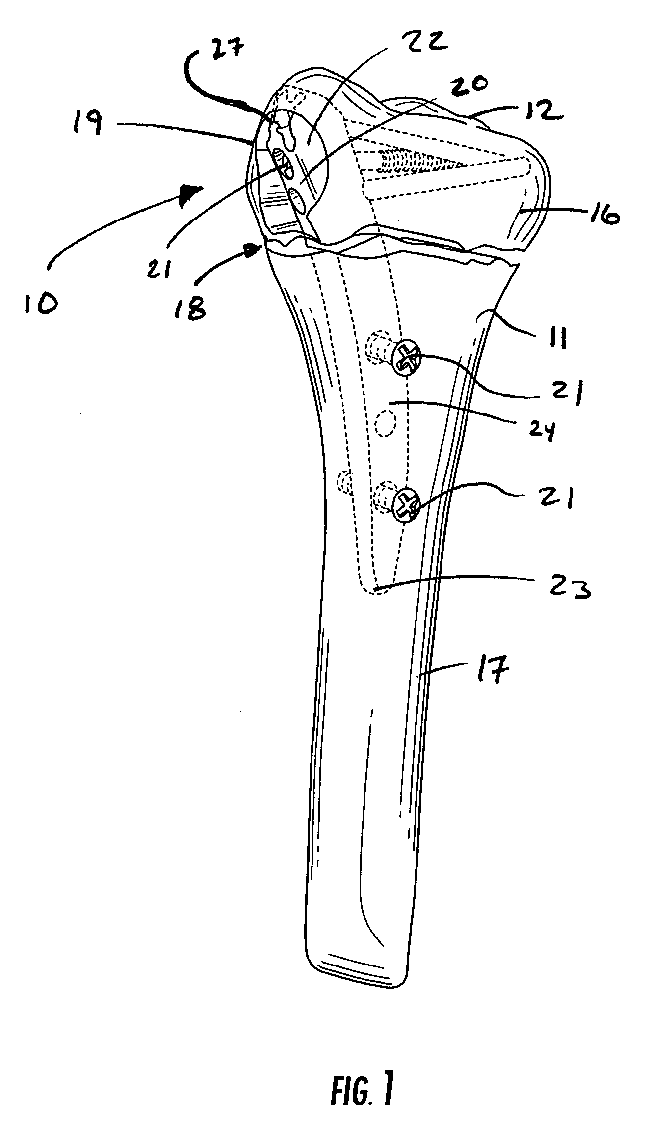 Guide assembly for intramedullary fixation and method of using the same